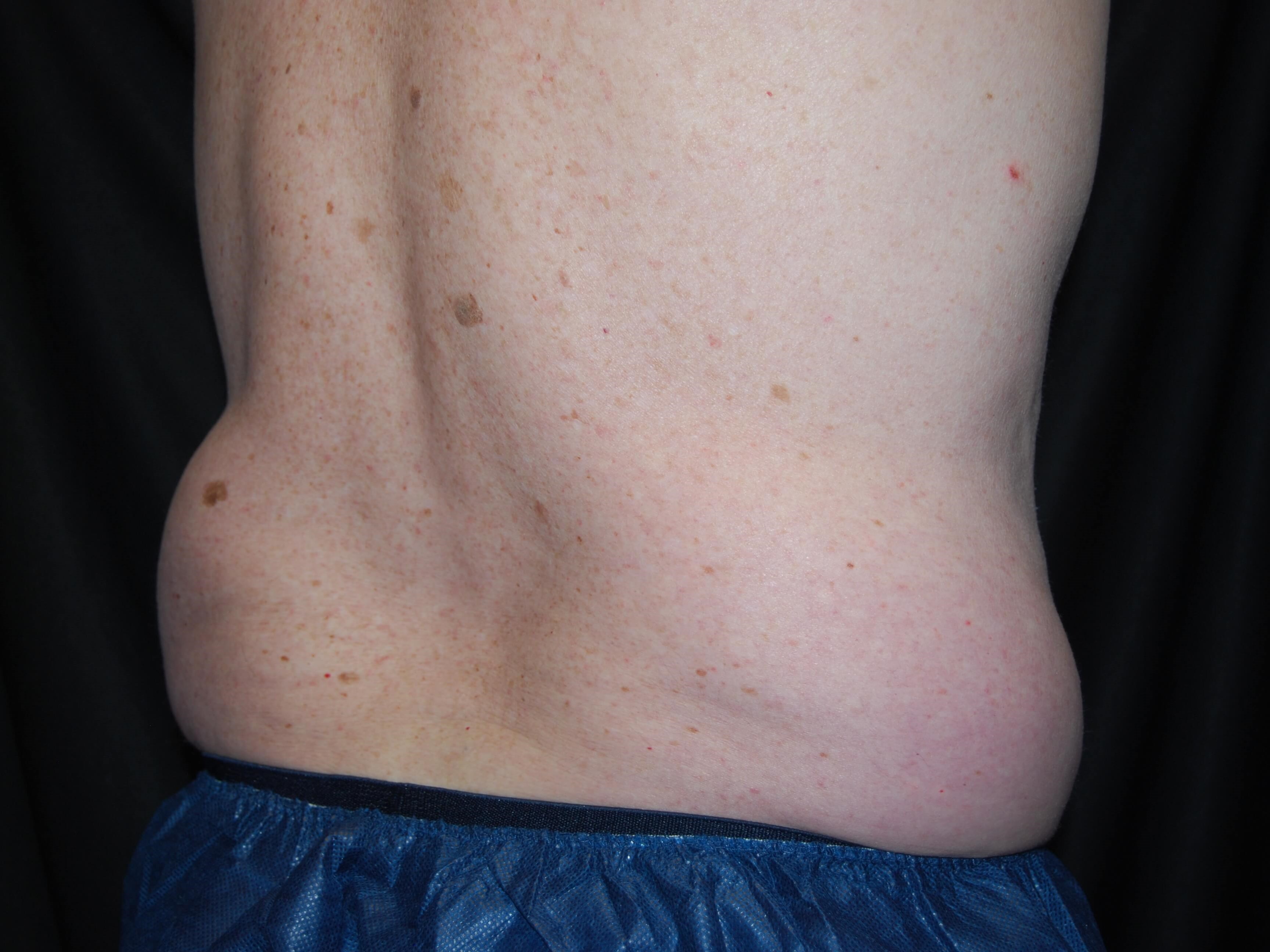 Right Side View - Flank Before Coolsculpting