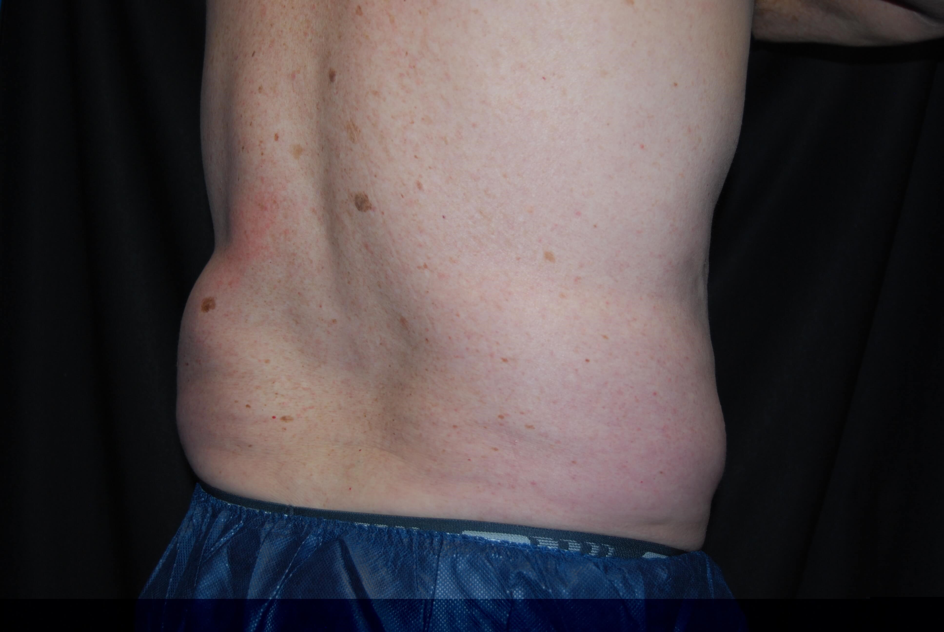 Right Side View - Flank After Coolsculpting