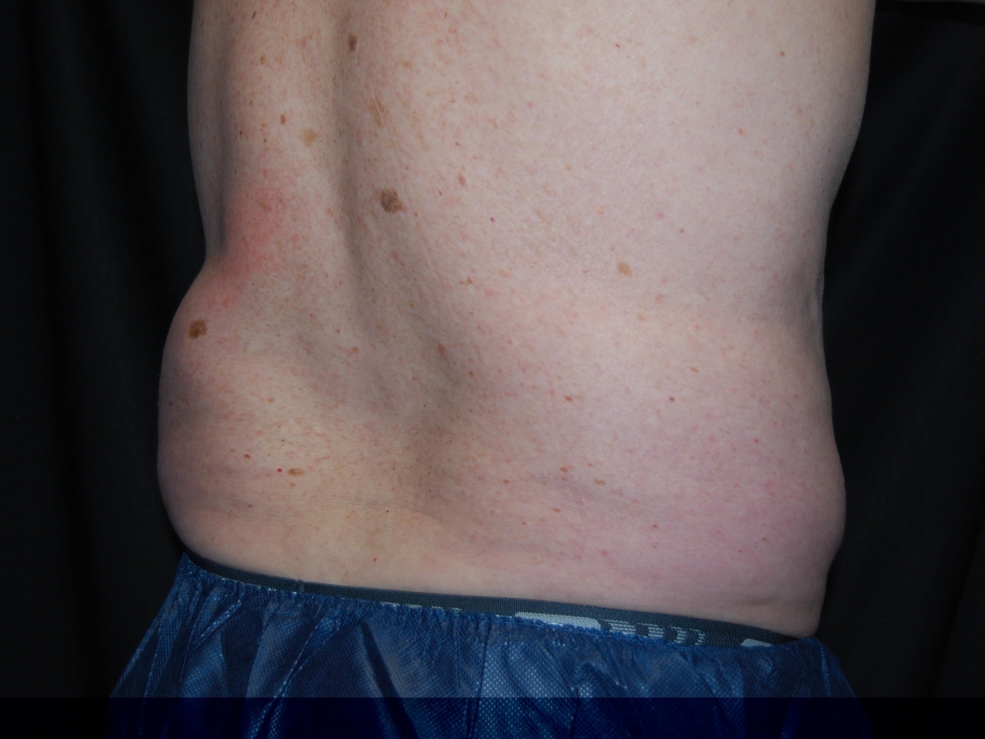 Right Side View - Flank After Coolsculpting