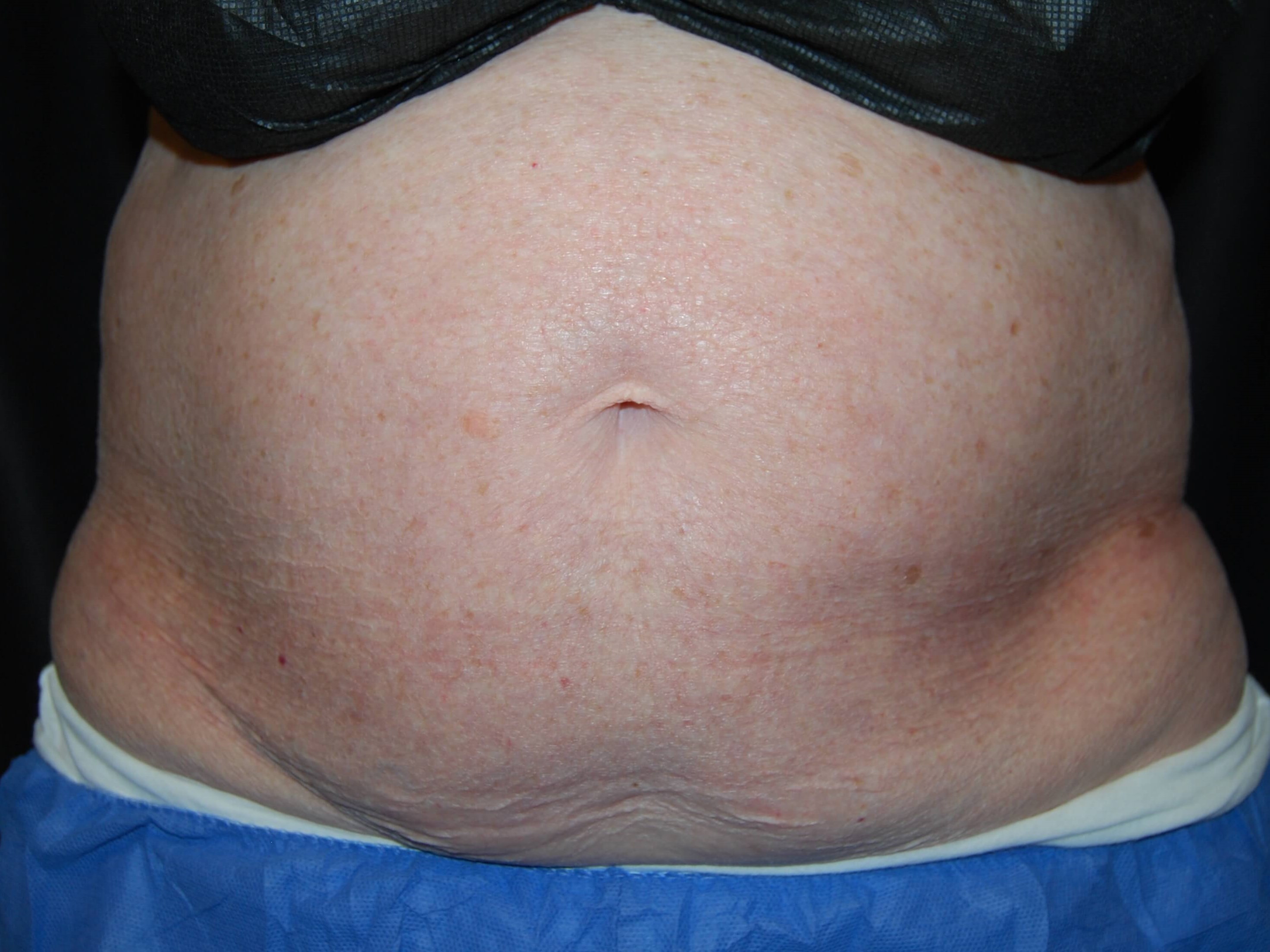 Coolsculpting Front View Before Coolsculpting