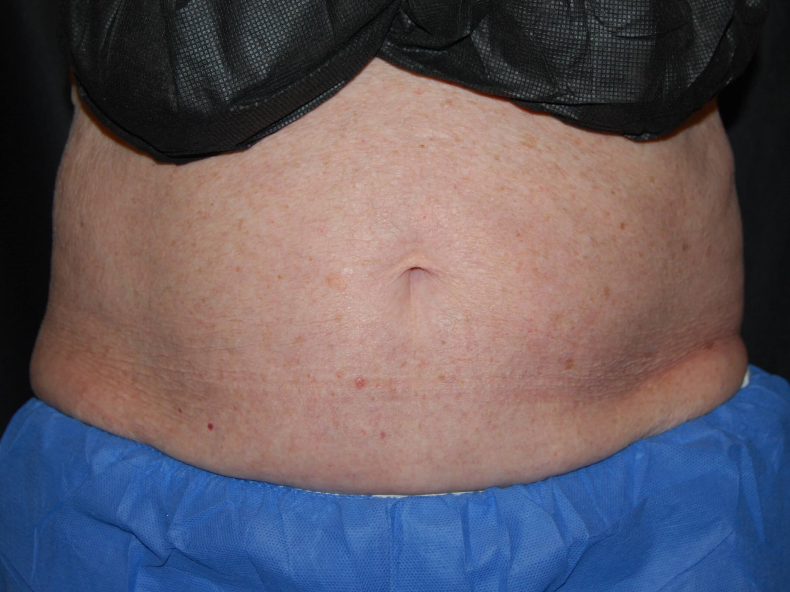 Coolsculpting Front View After Coolsculpting