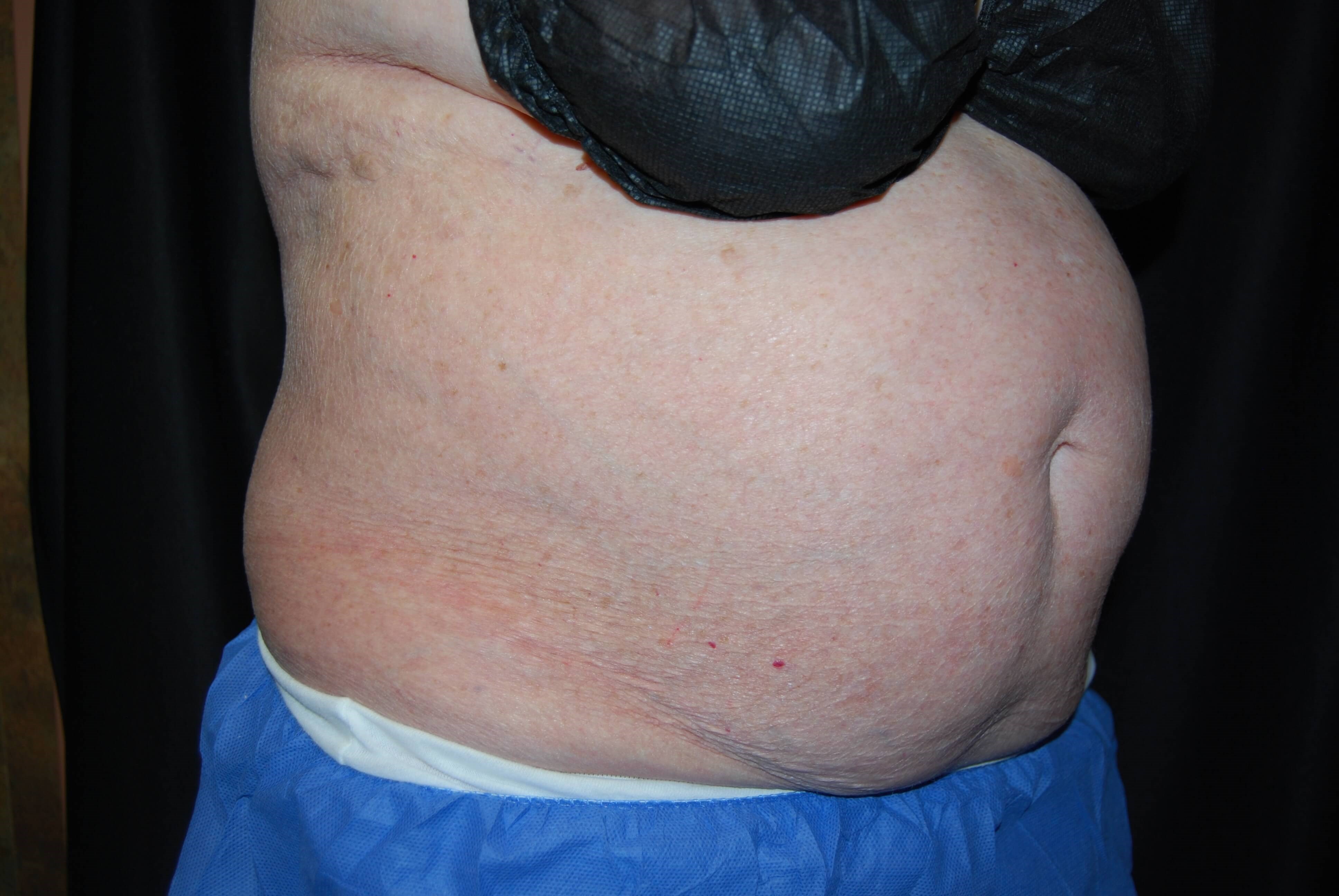 Coolsculpting Side View Before Coolsculpting