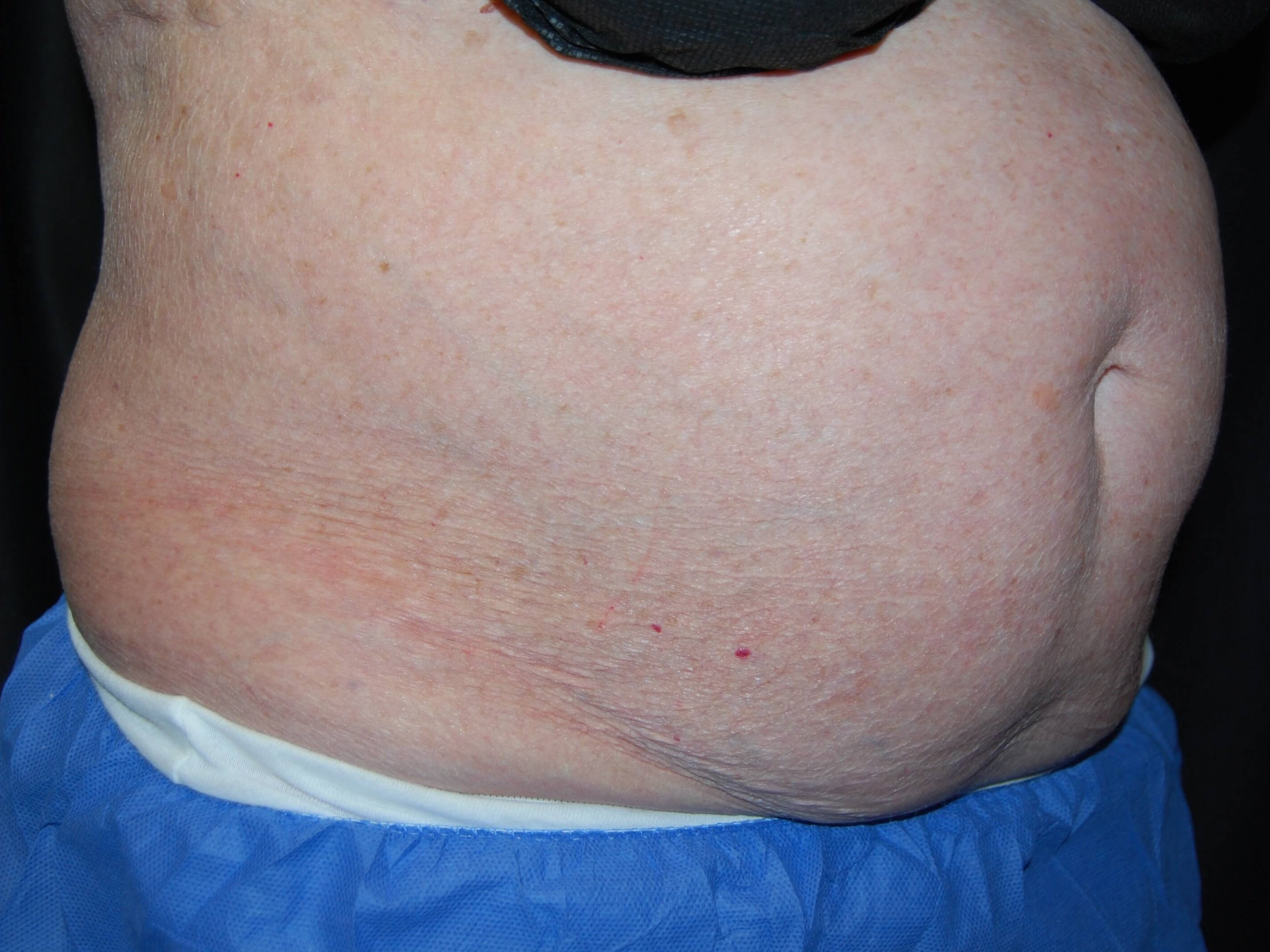 Coolsculpting Side View Before Coolsculpting