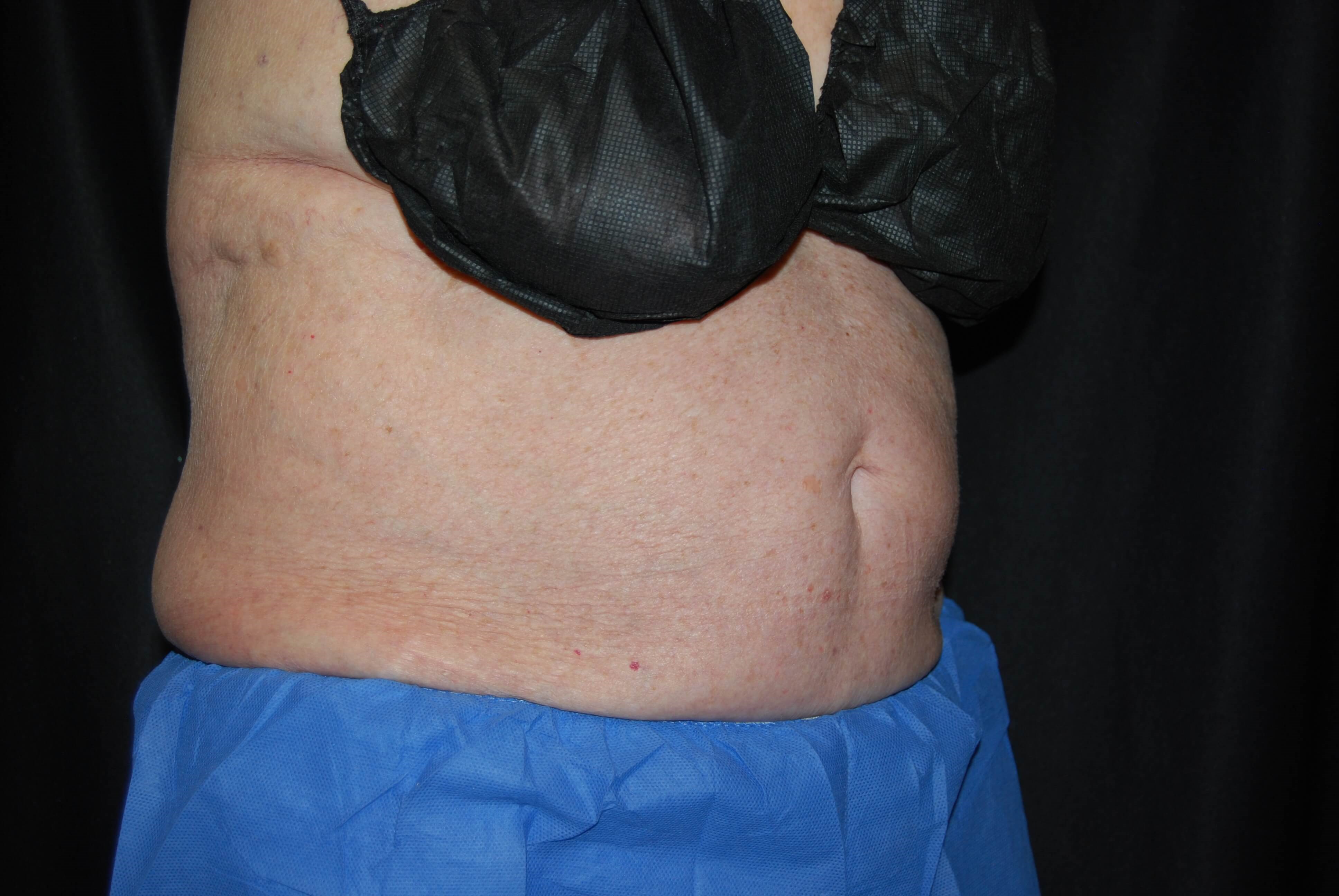 Coolsculpting Side View After Coolsculpting