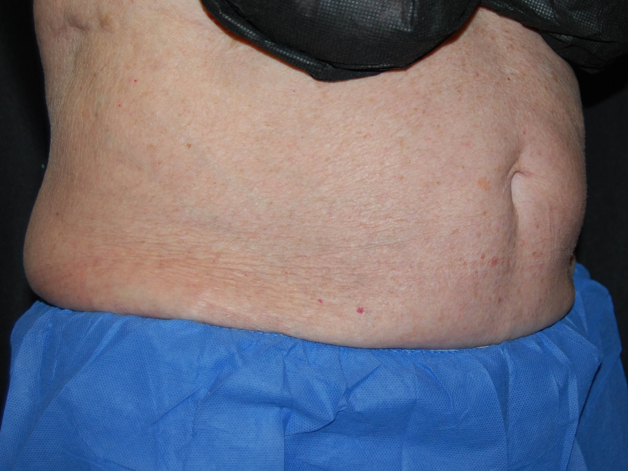 Coolsculpting Side View After Coolsculpting
