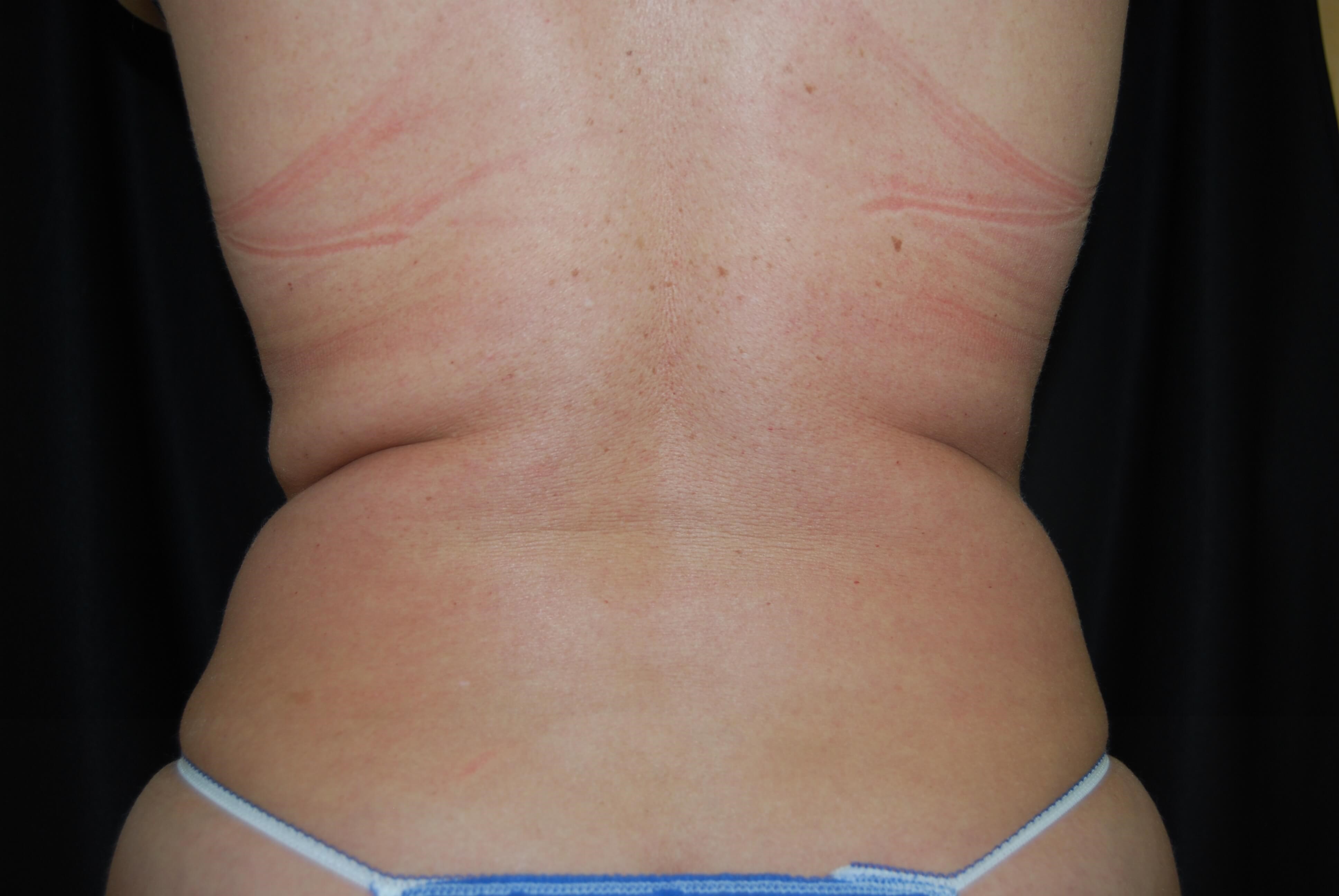 Back View - Flanks Before Coolsculpting