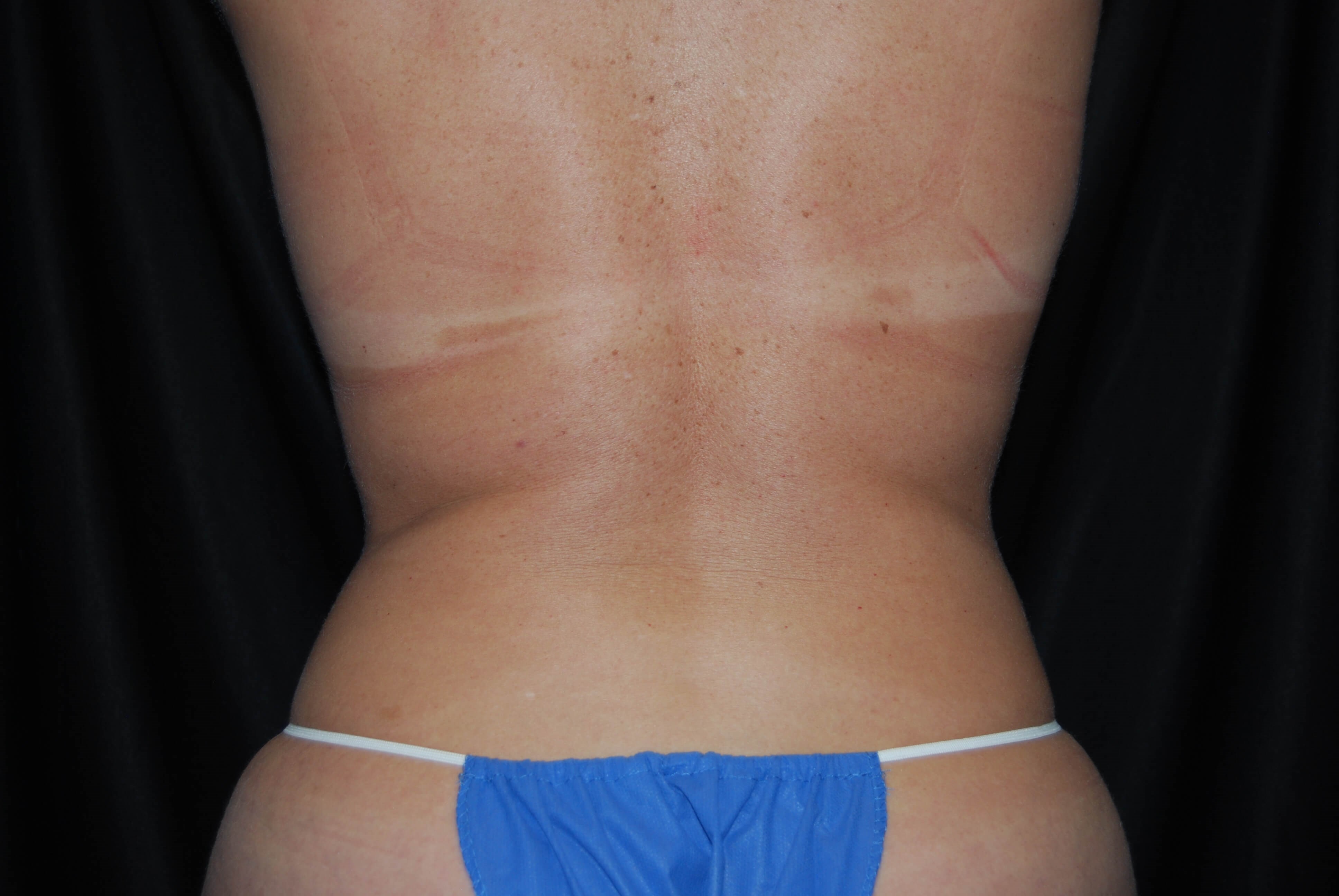Back View - Flanks After Coolsculpting