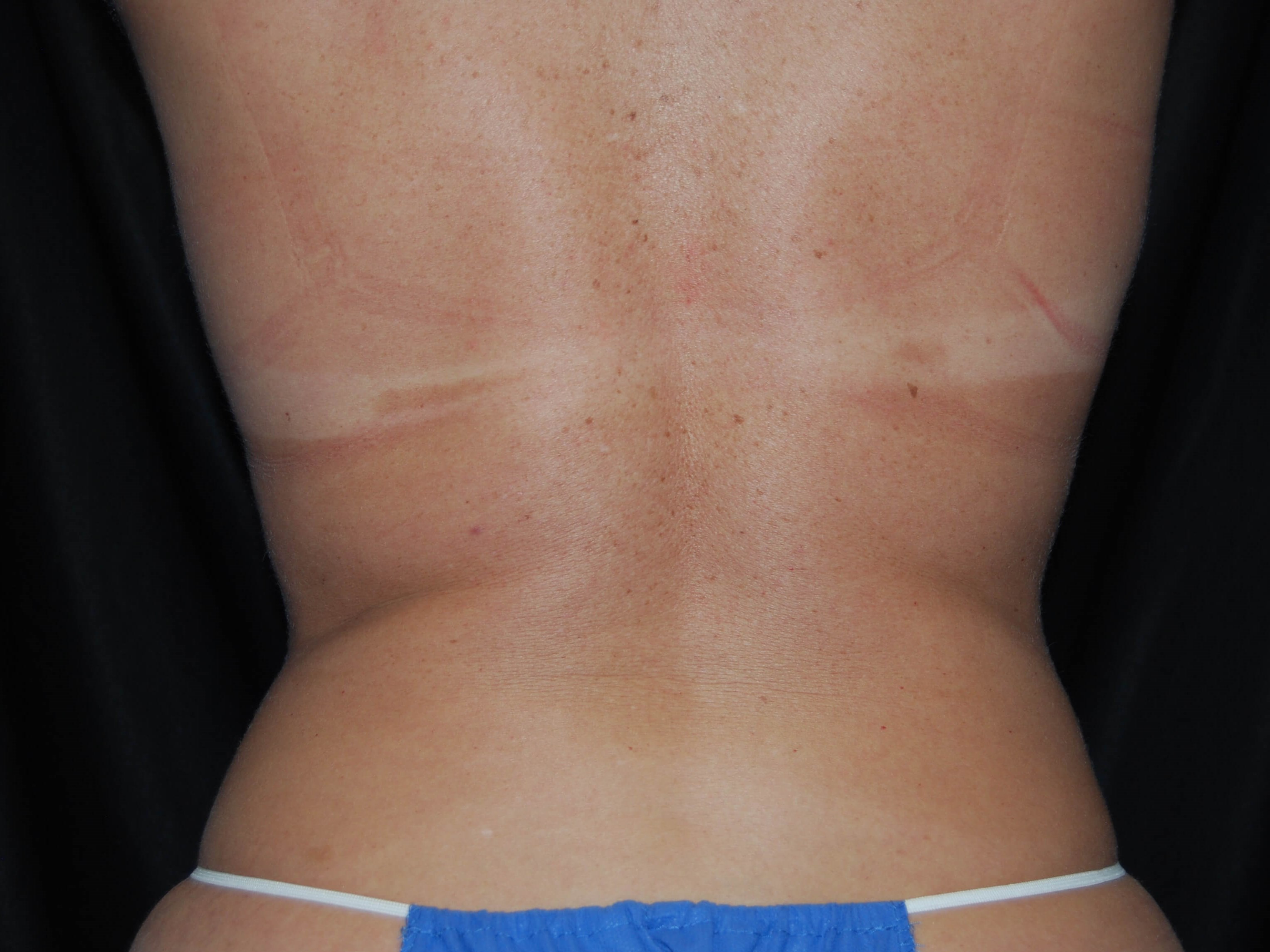 Back View - Flanks After Coolsculpting