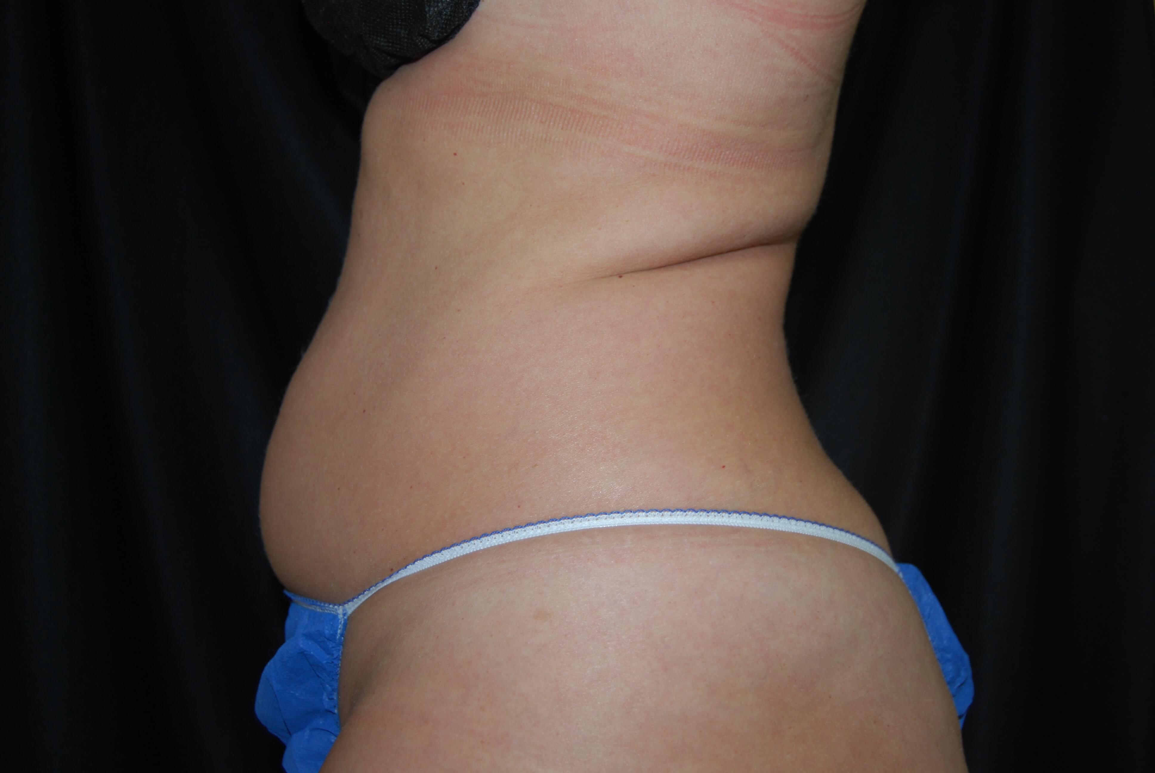 Side View - Abdomen Before Coolsculpting