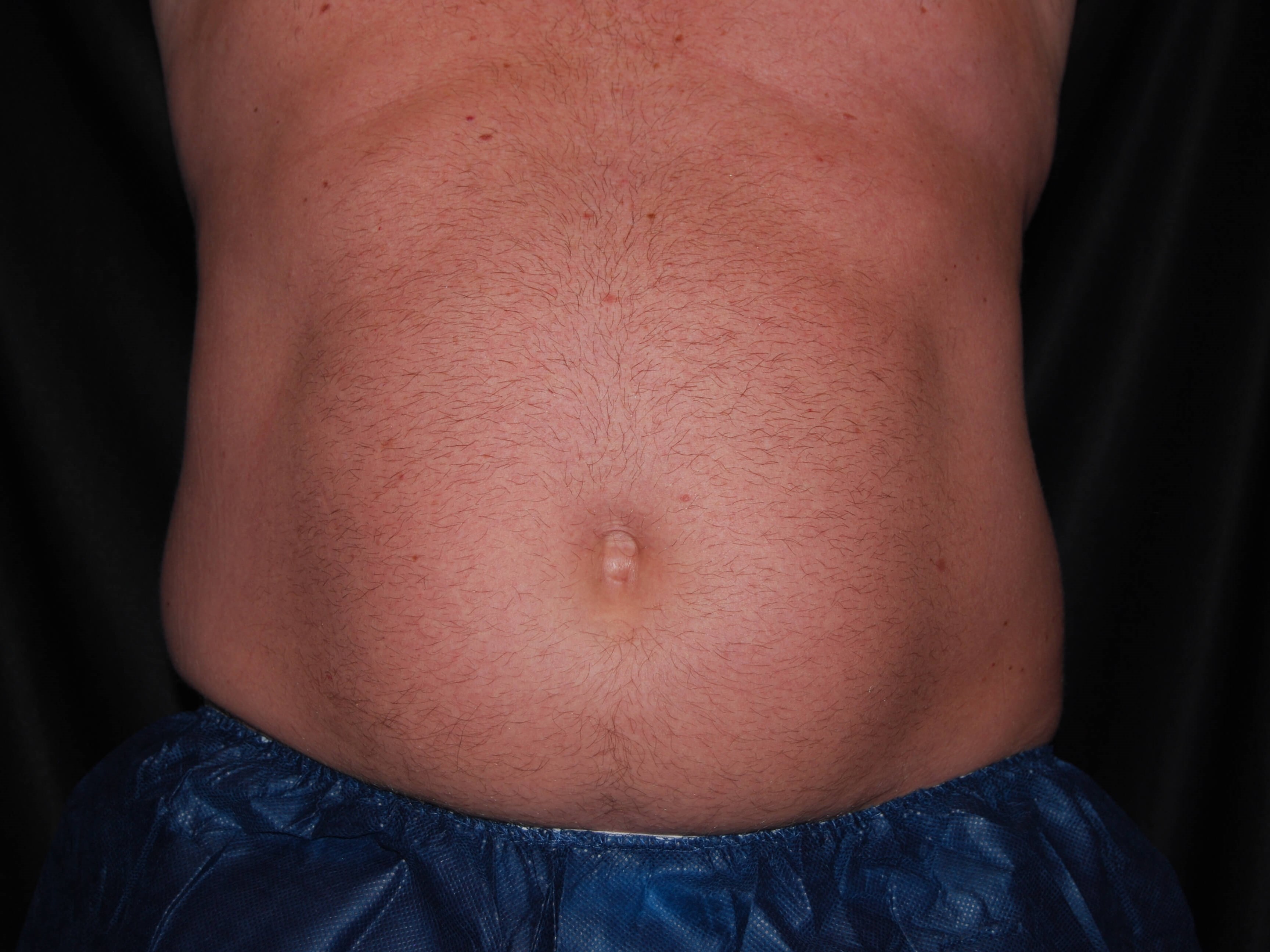Coolsculpting Abdomen After Coolsculpting