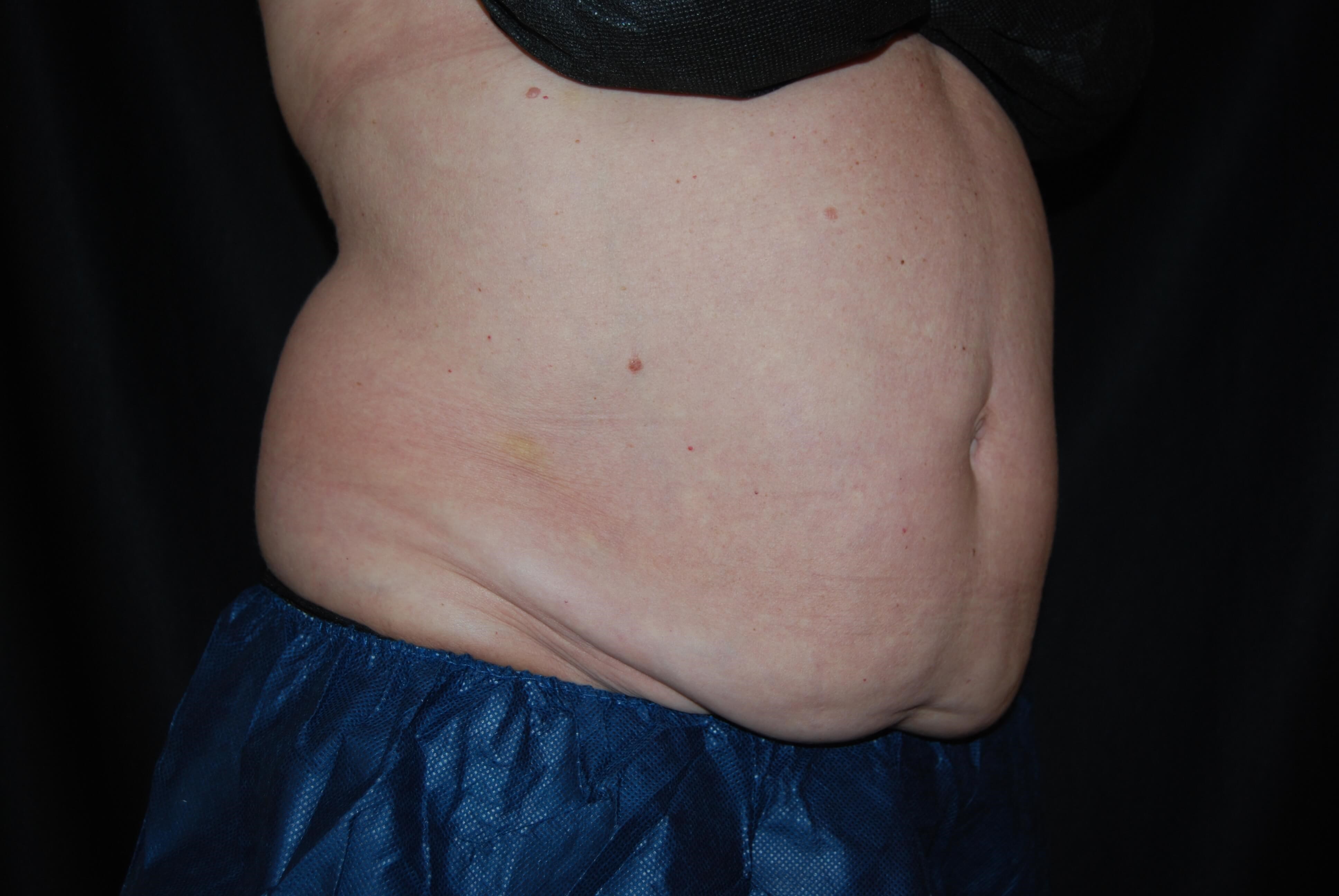 Side View Before Coolsculpting