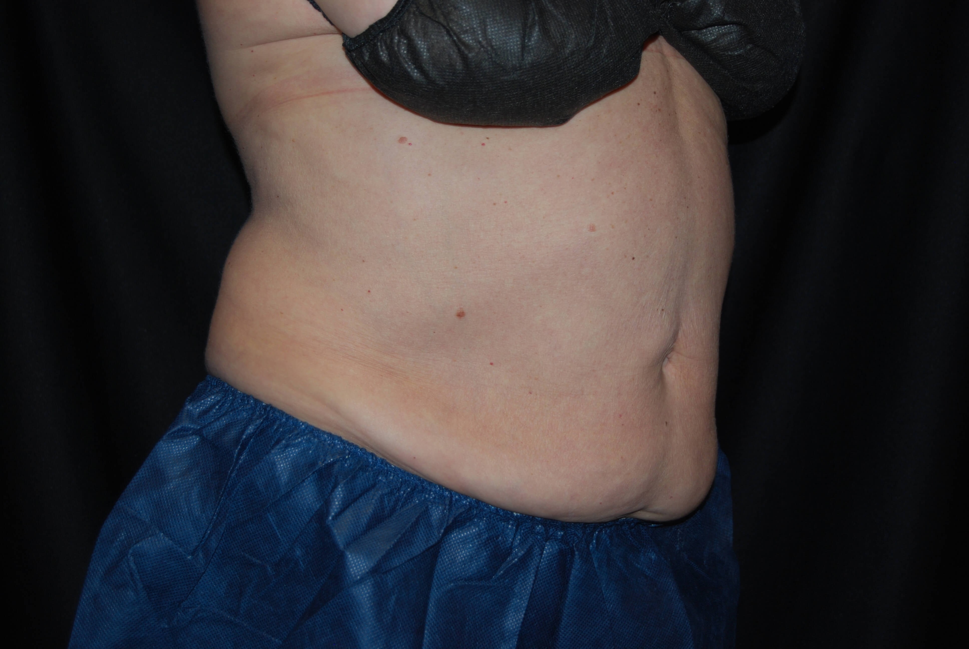 Side View After Coolsculpting