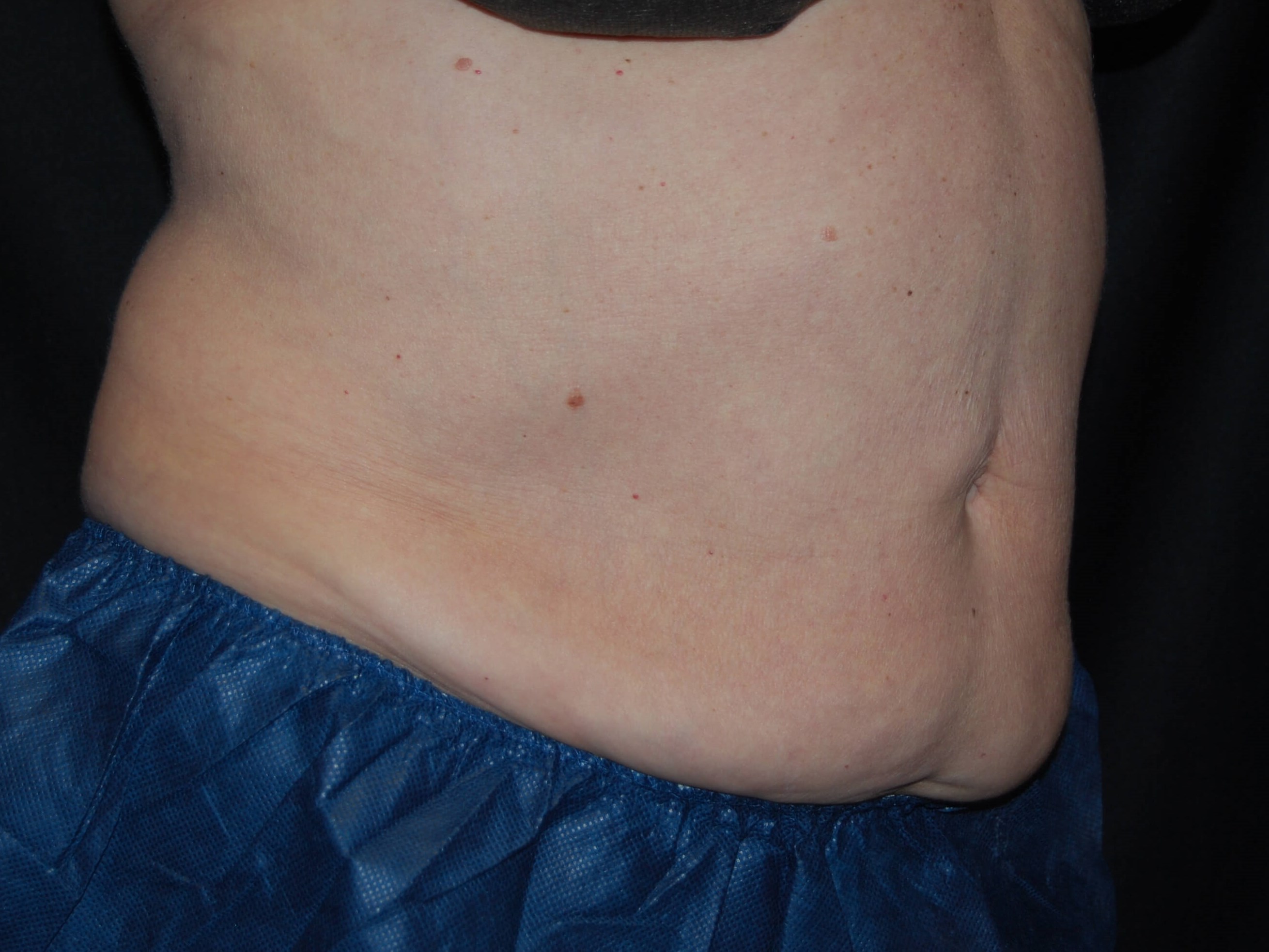 Side View After Coolsculpting