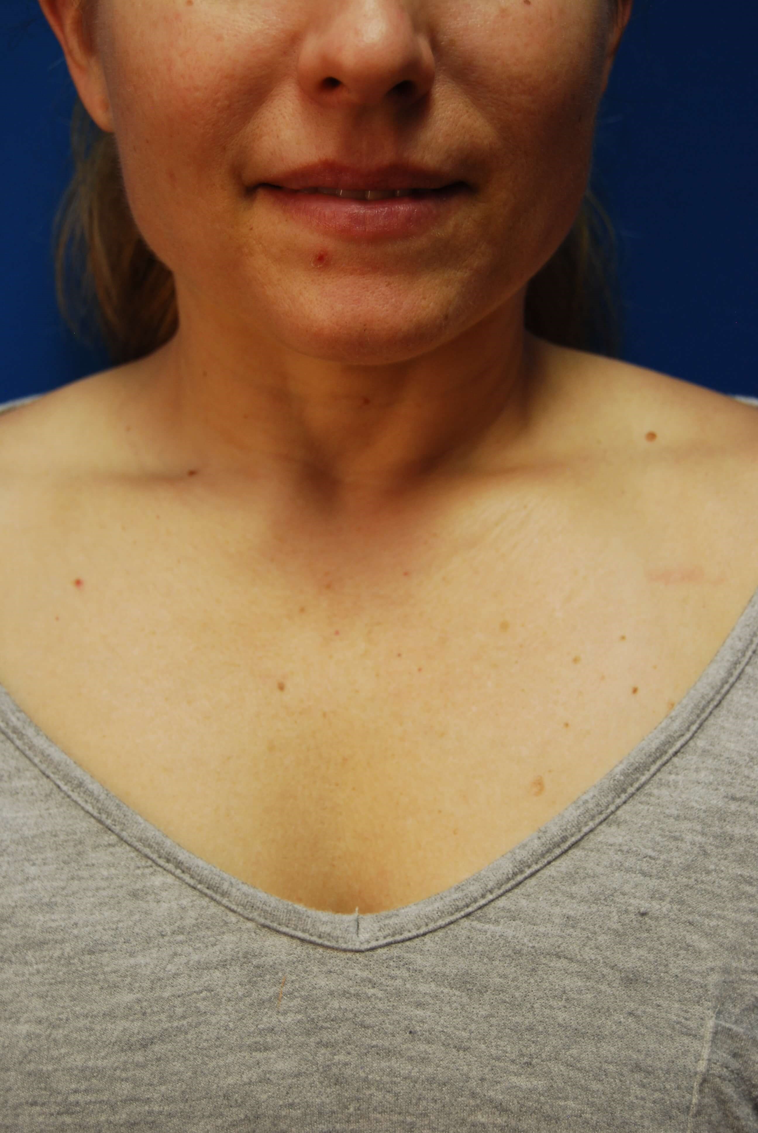 Broad Band Light - Chest Before