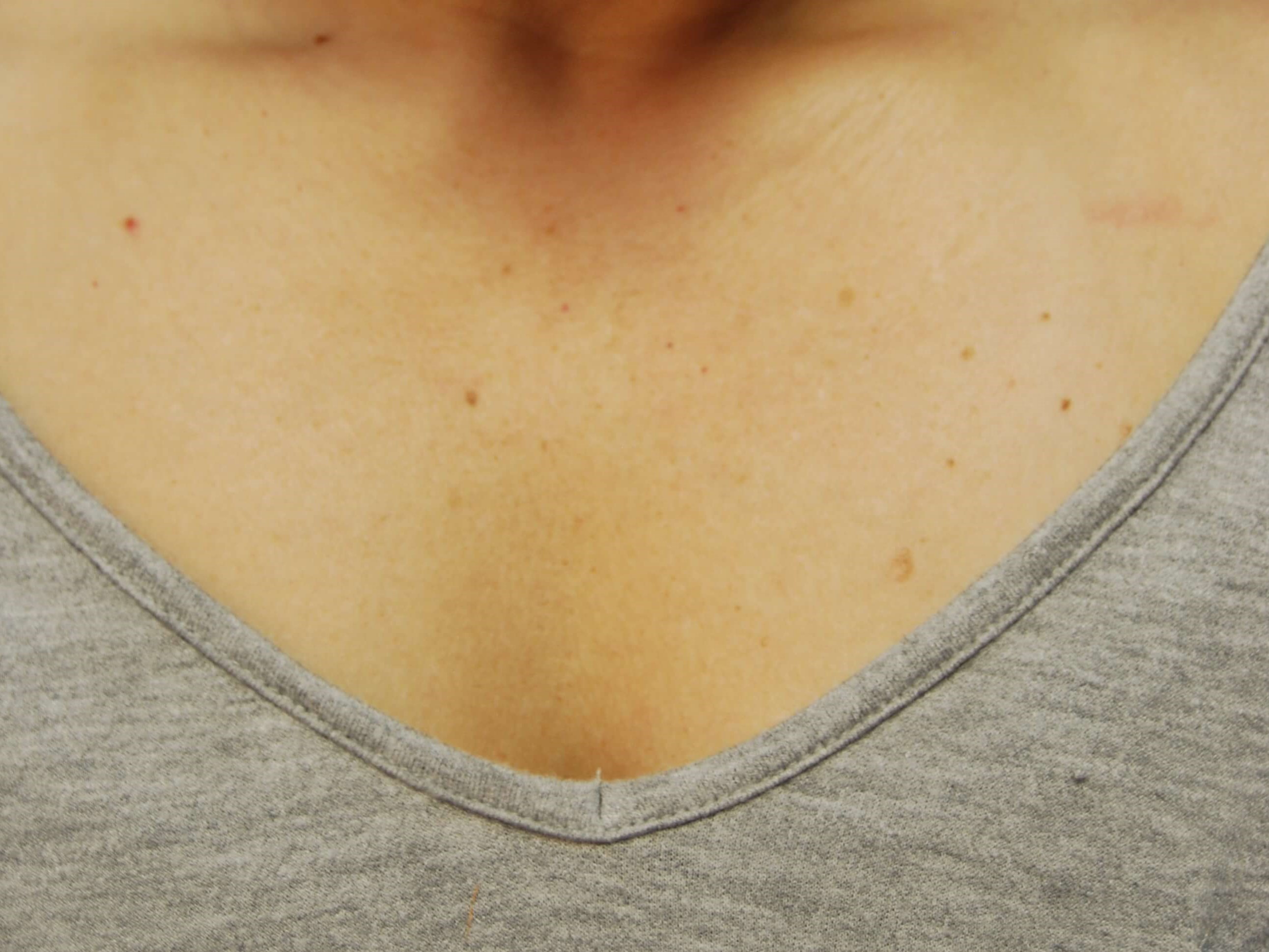 Broad Band Light - Chest Before