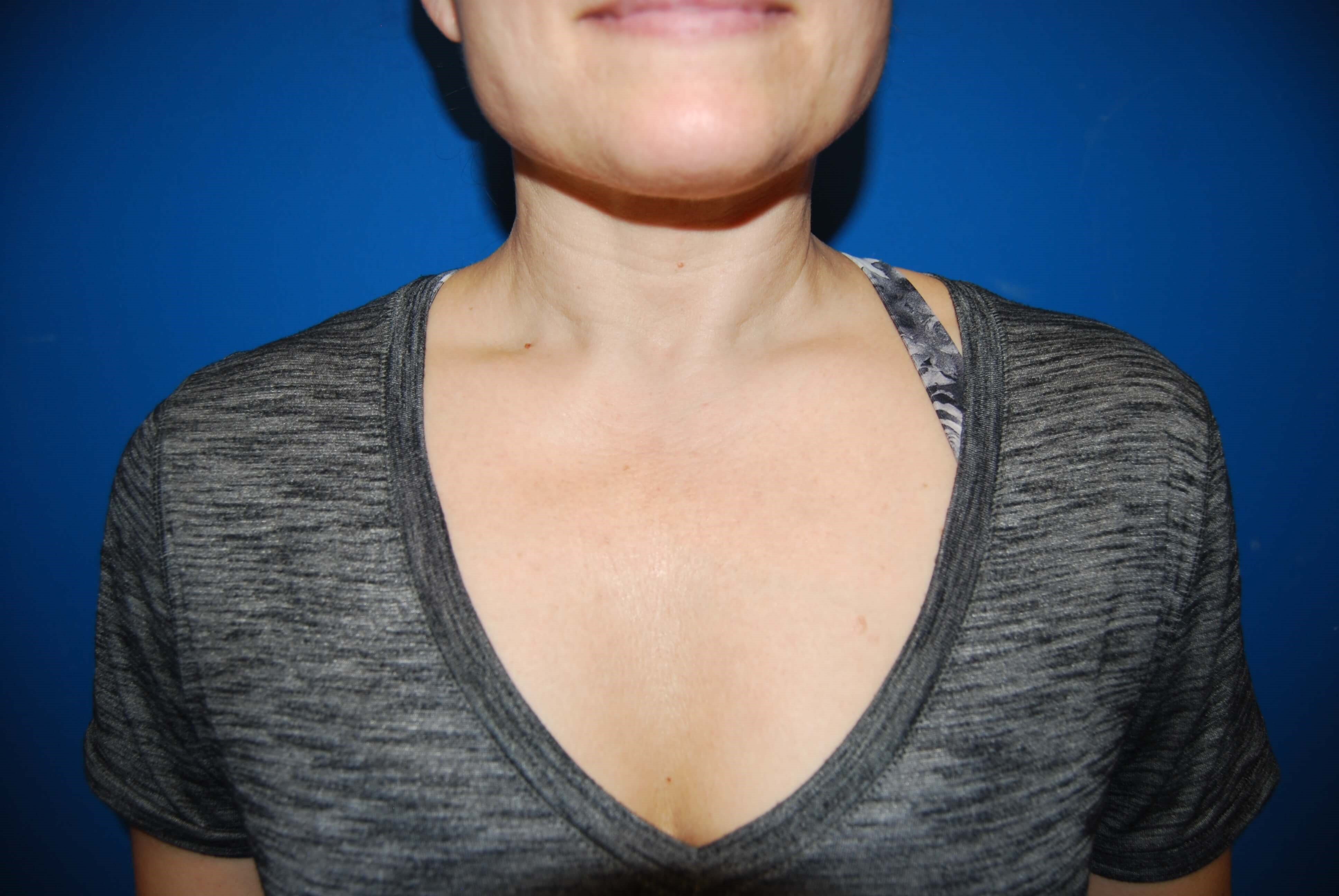 Broad Band Light - Chest After