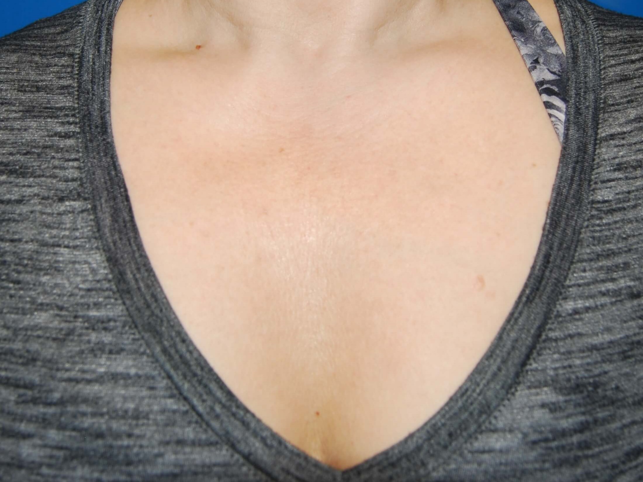 Broad Band Light - Chest After