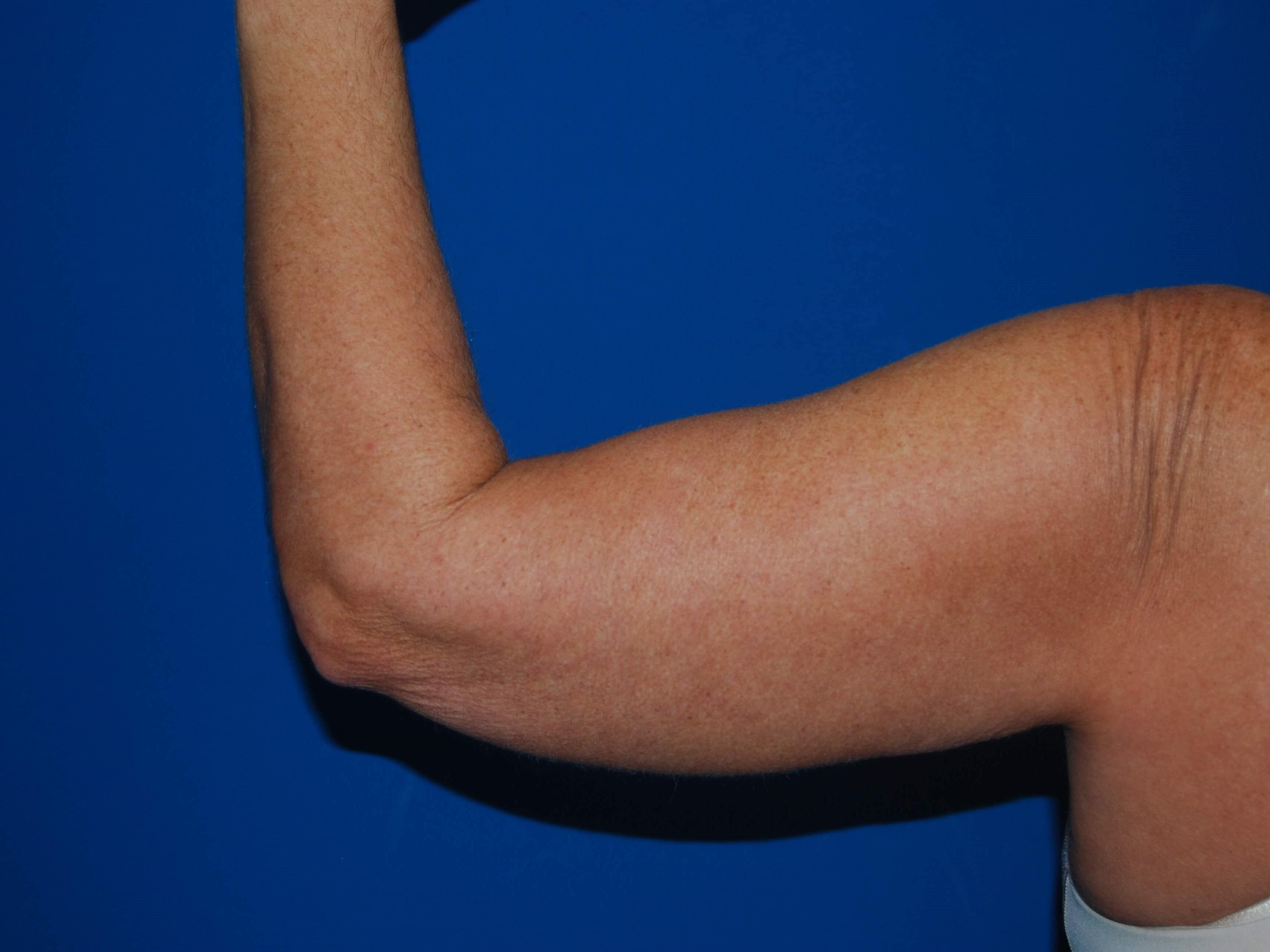 Left Arm Before Arm Lift
