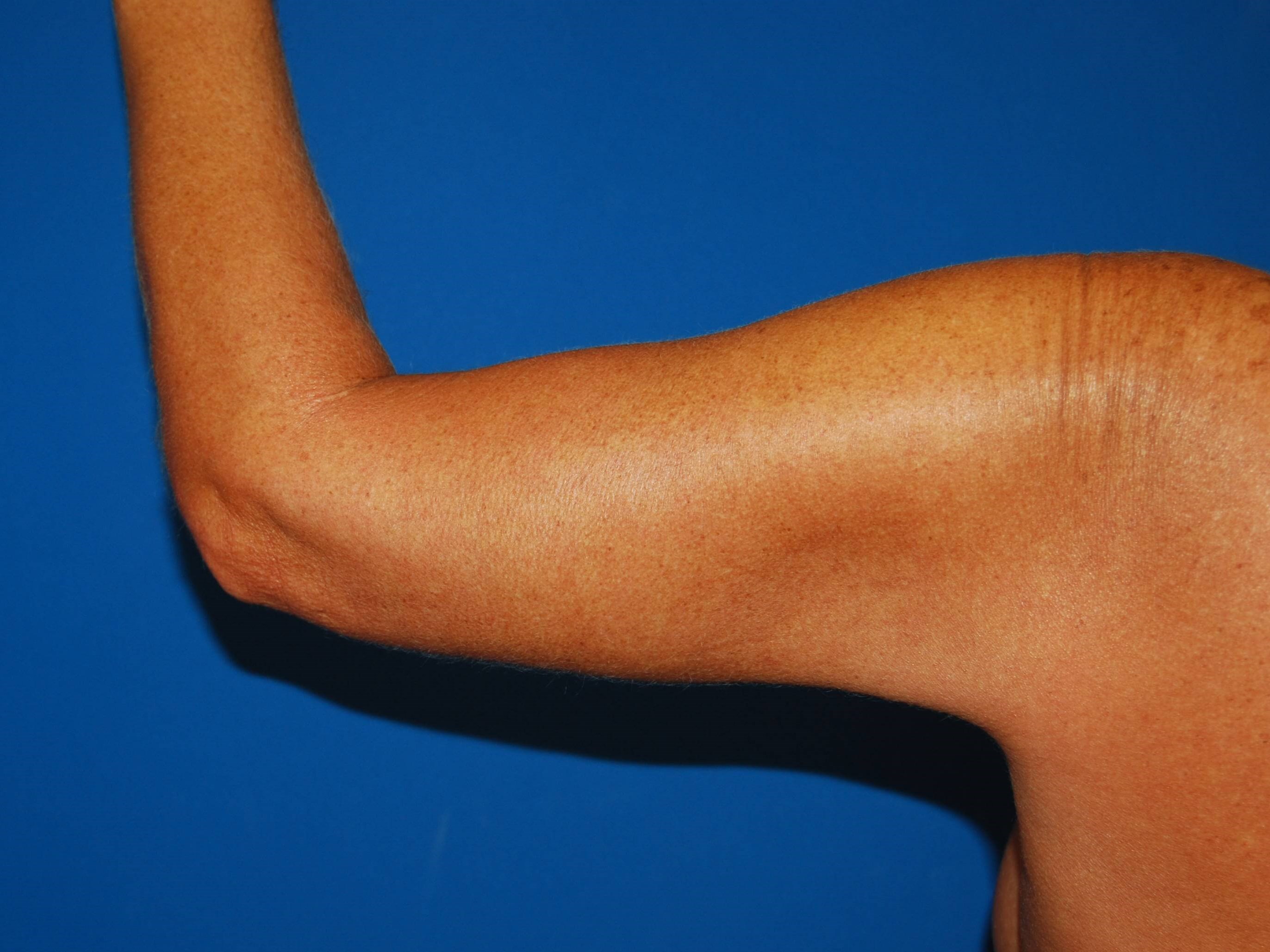 Left Arm After Arm Lift