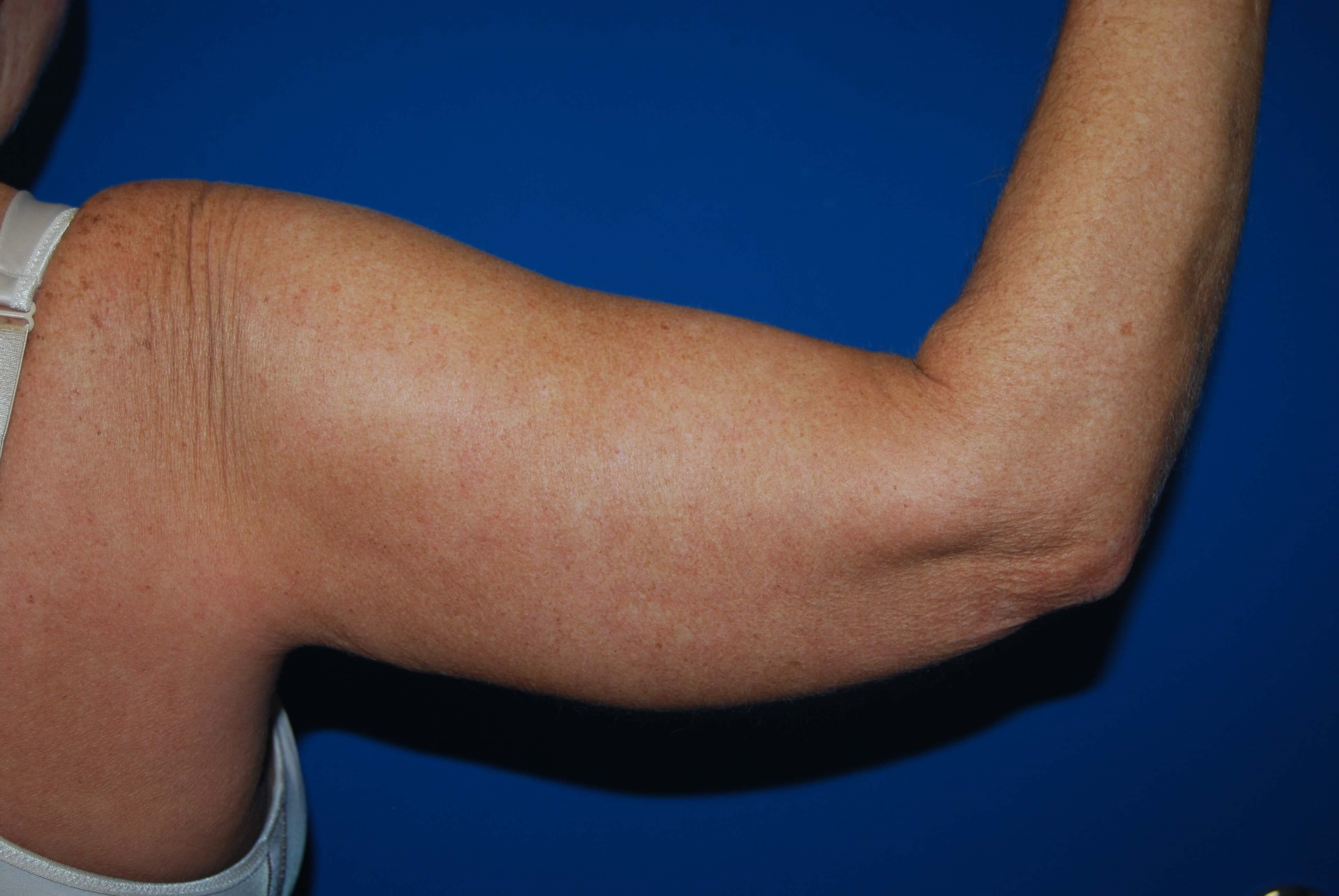 Right Arm Before Arm Lift