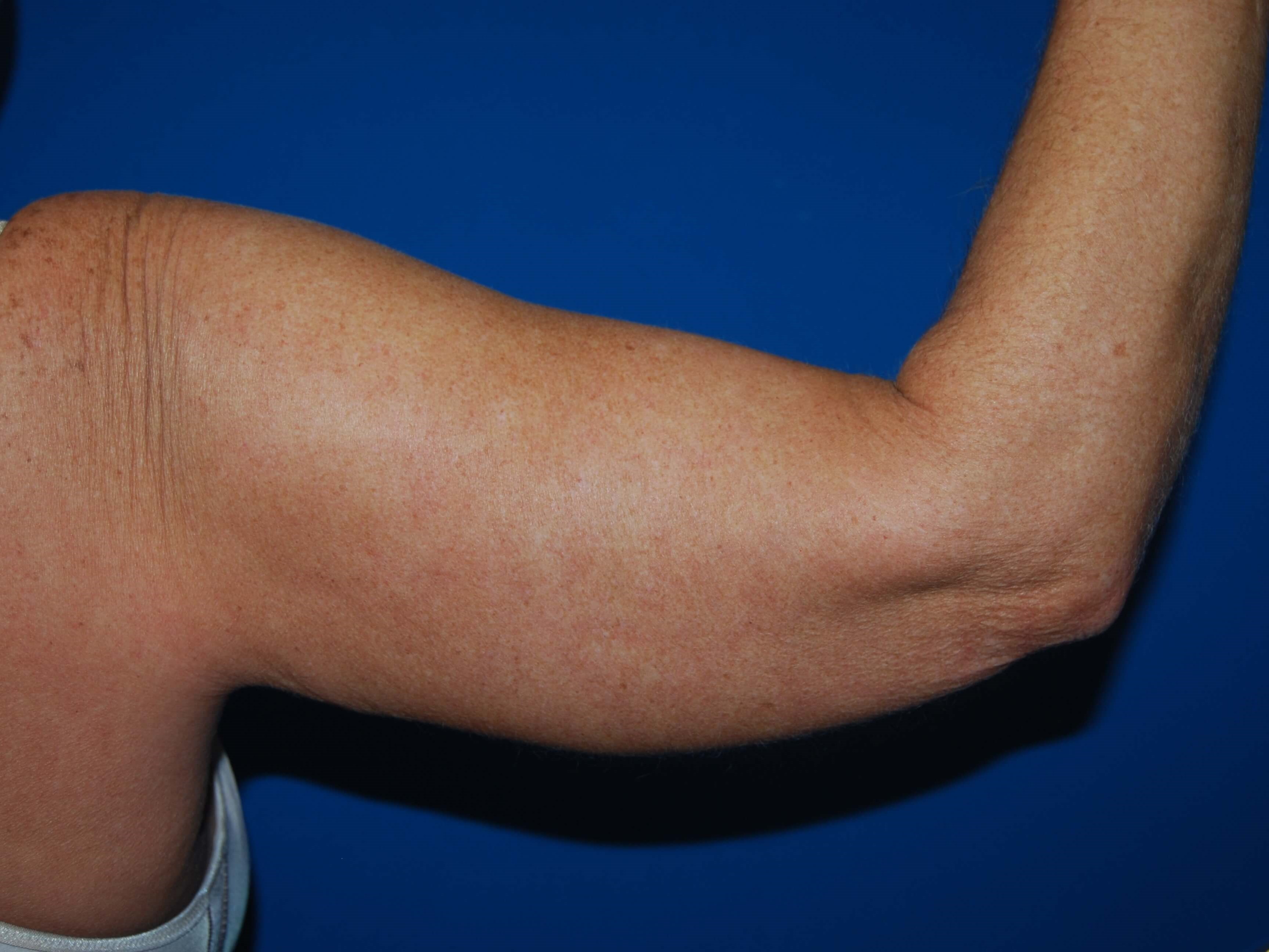 Right Arm Before Arm Lift