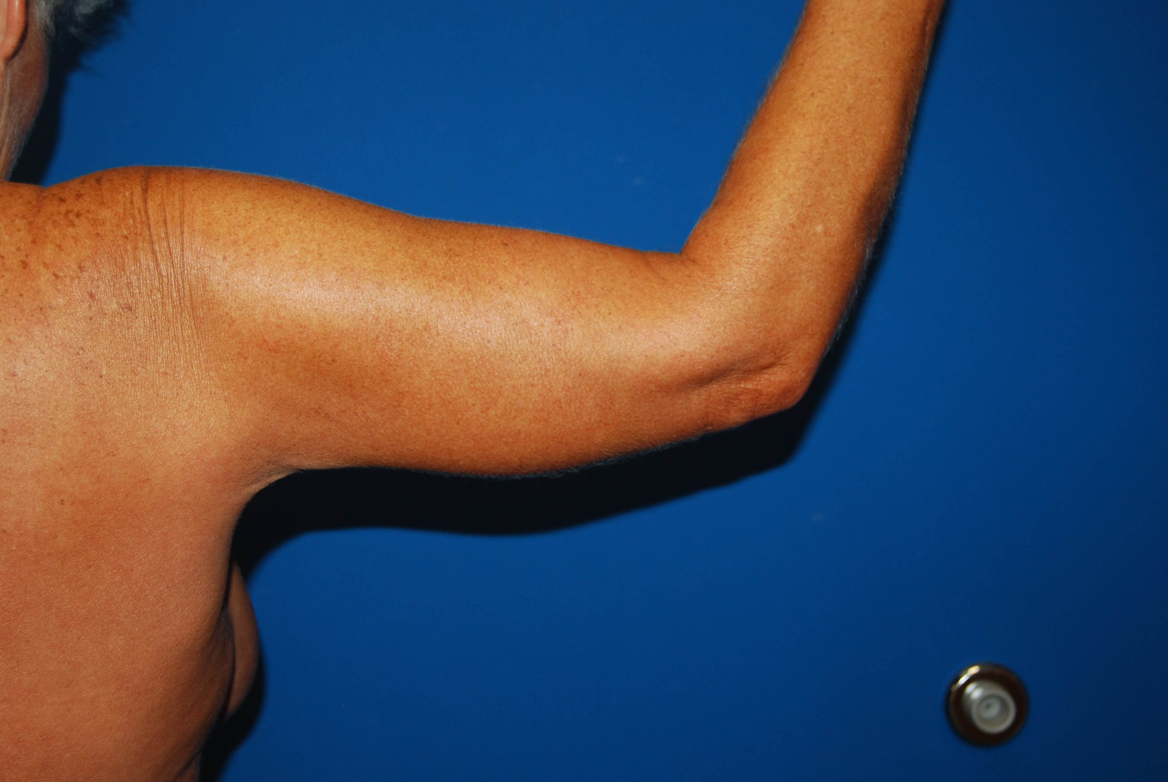 Right Arm After Arm Lift