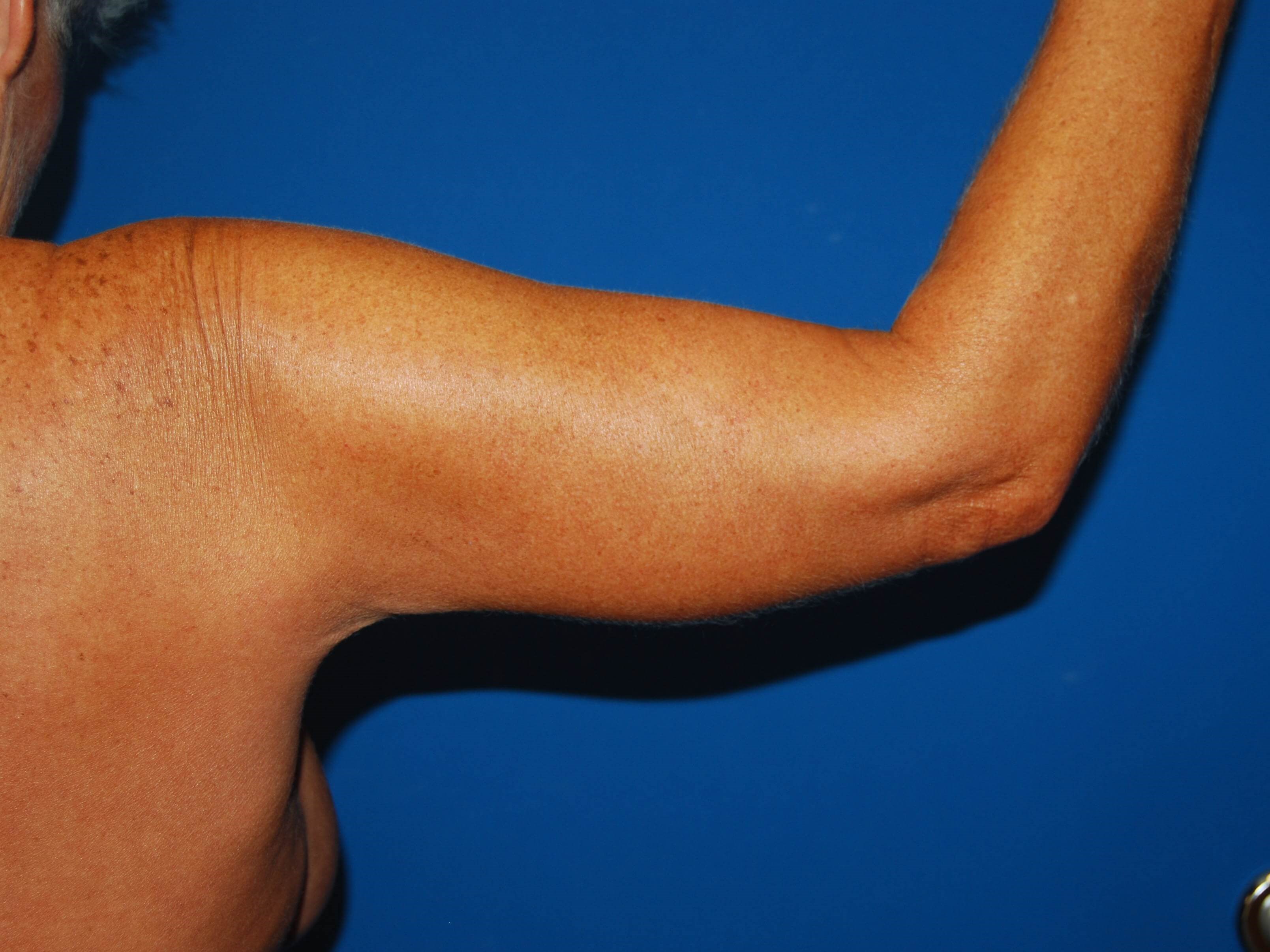 Right Arm After Arm Lift