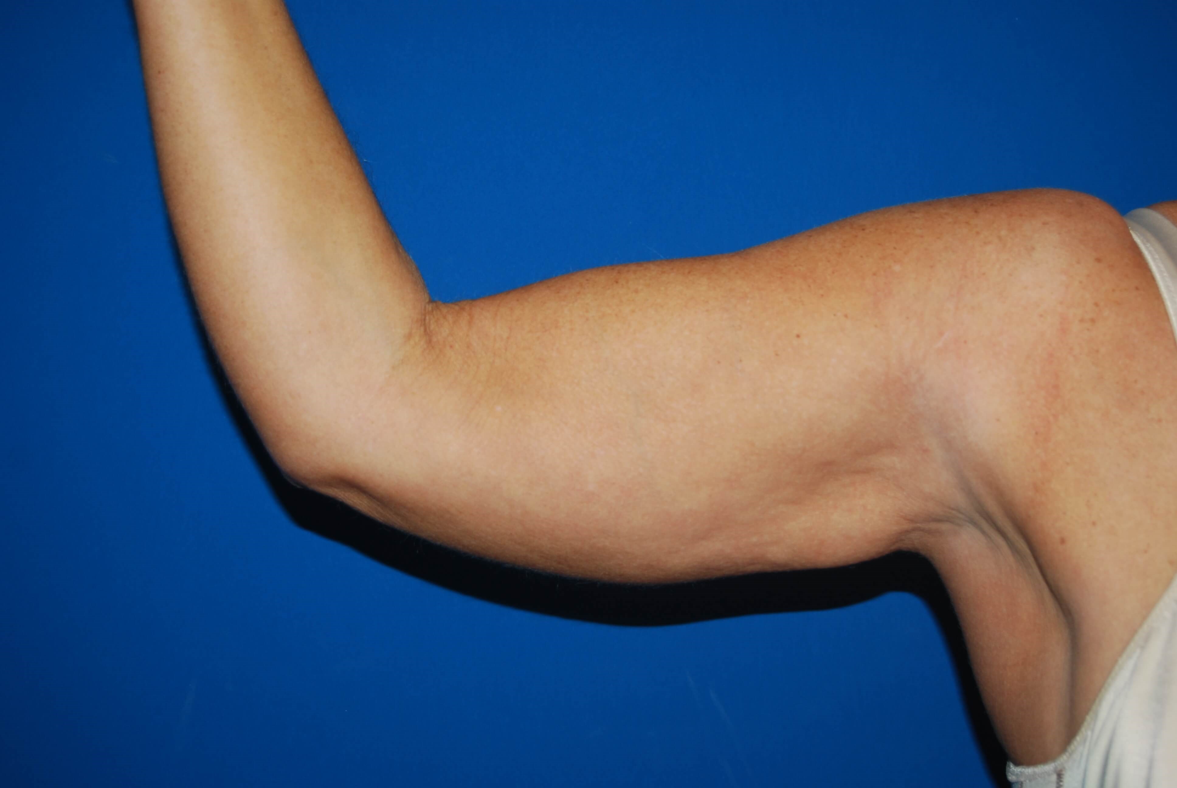 Right Arm Inner Before Arm Lift