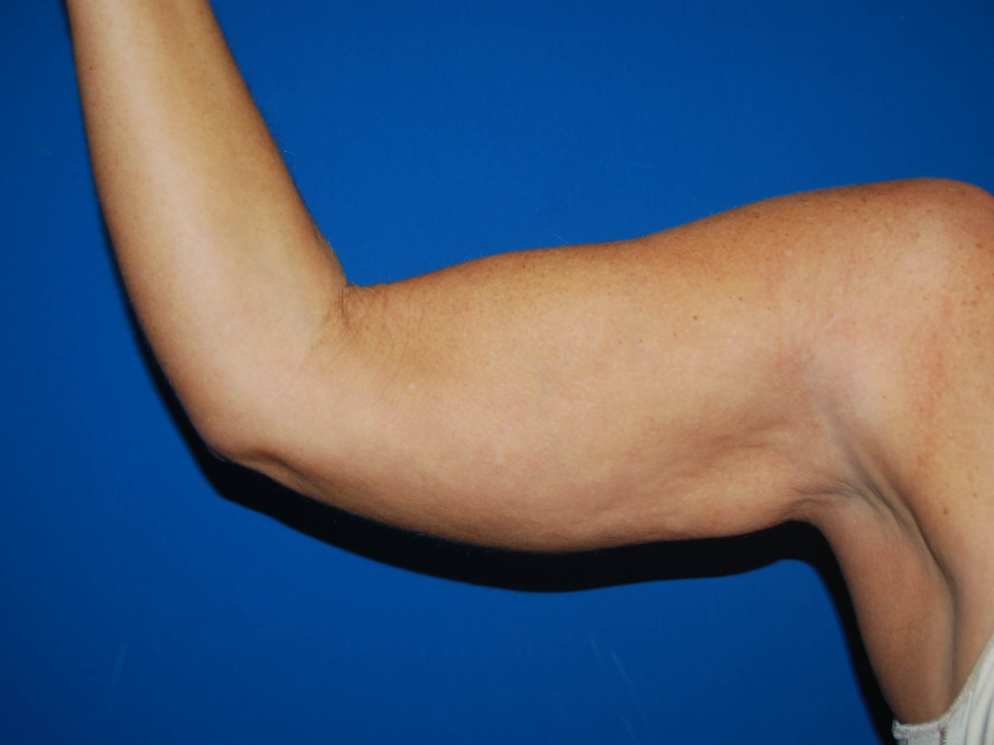Right Arm Inner Before Arm Lift