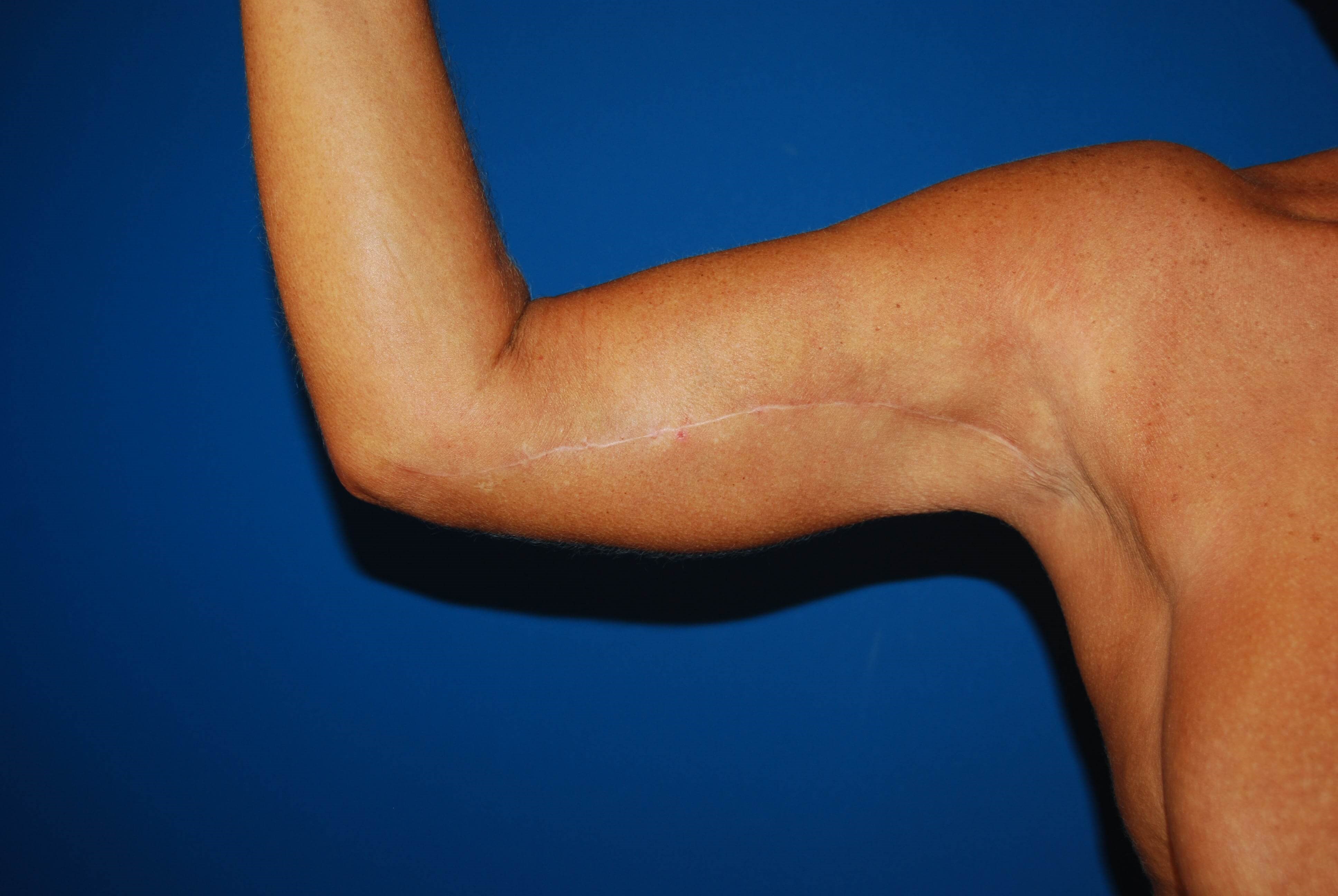Right Arm Inner After Arm Lift