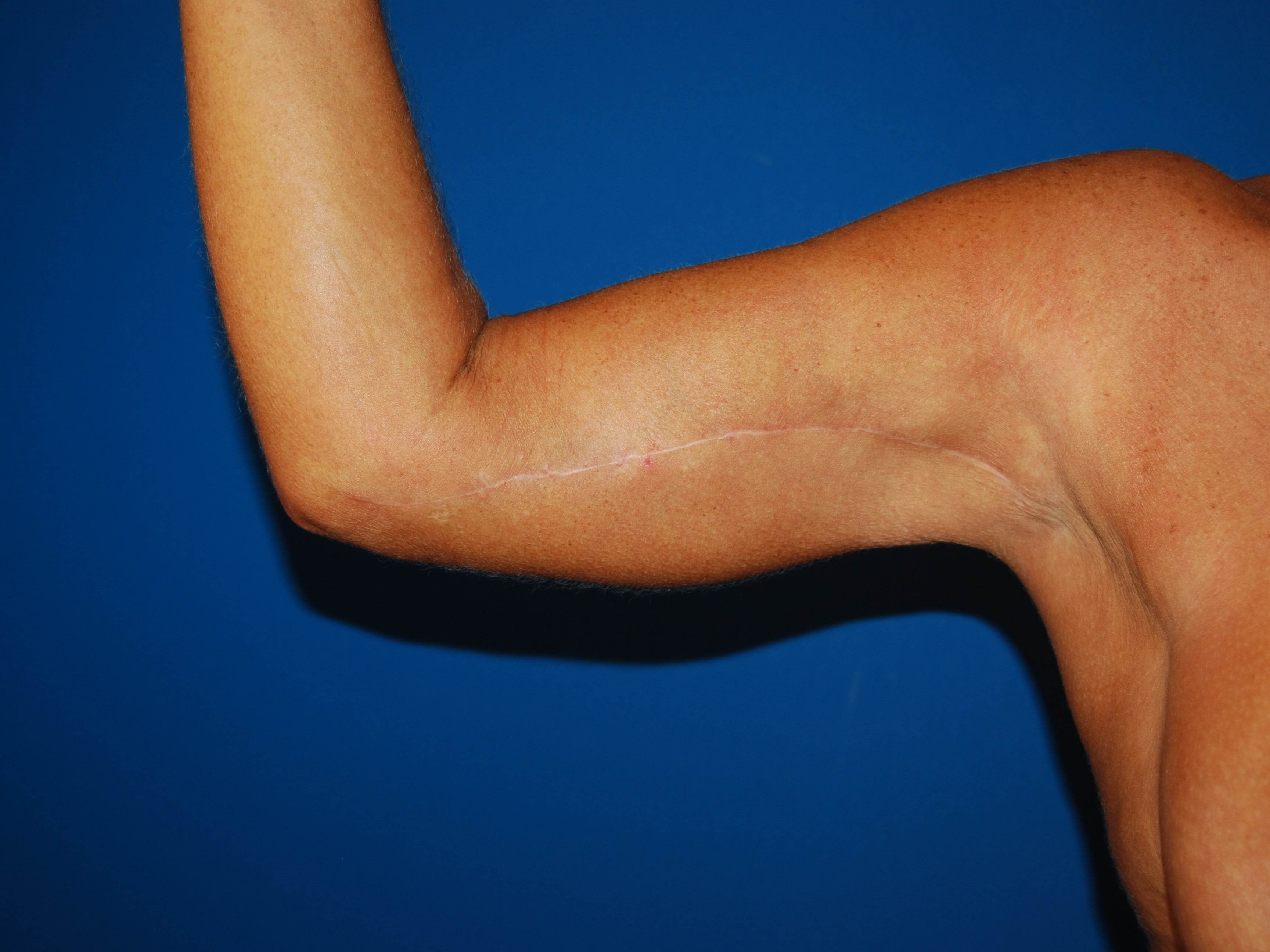 Right Arm Inner After Arm Lift