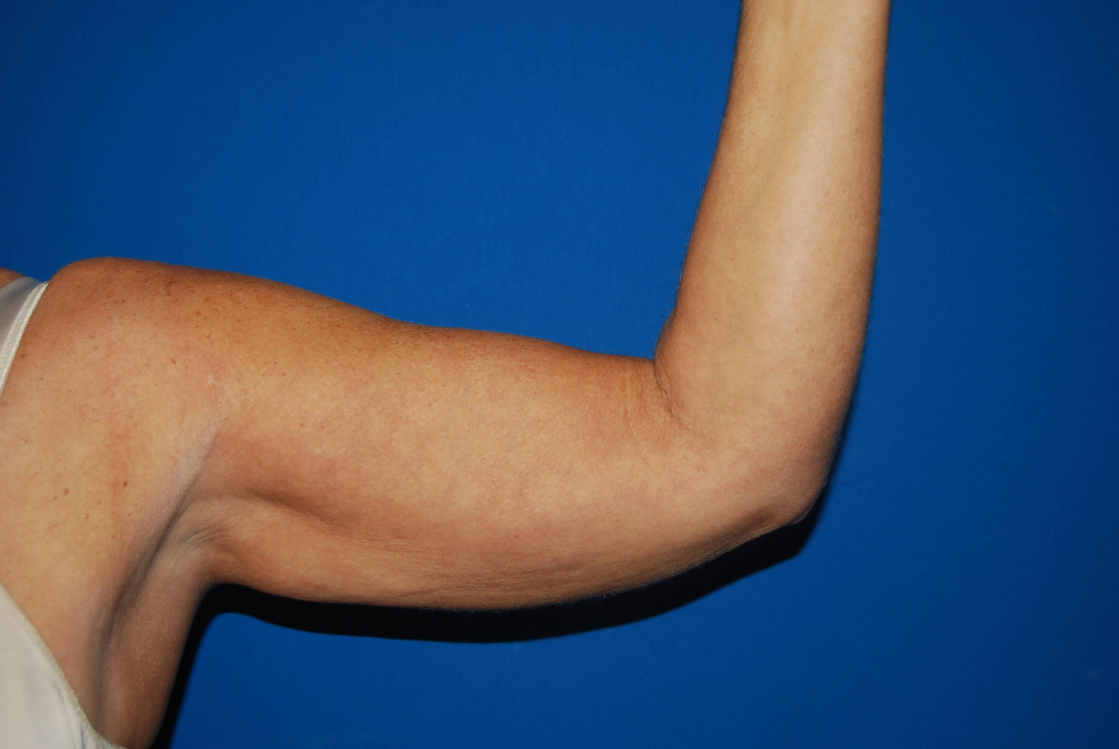 Left Arm Inner Before Arm Lift