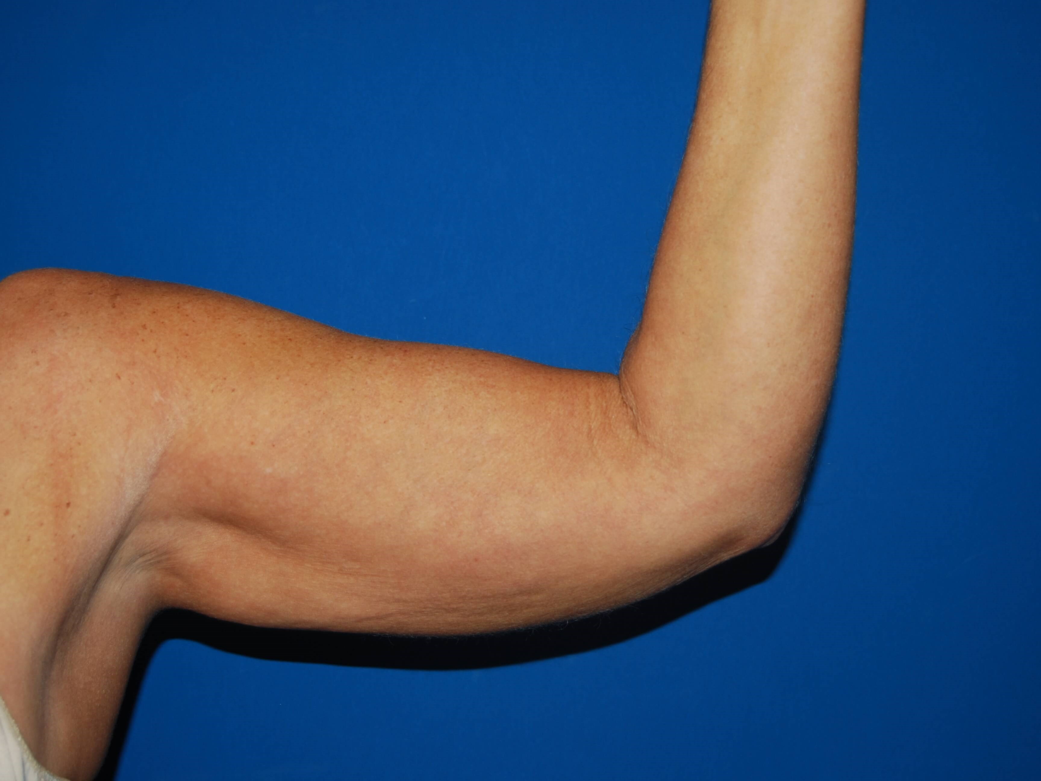 Left Arm Inner Before Arm Lift