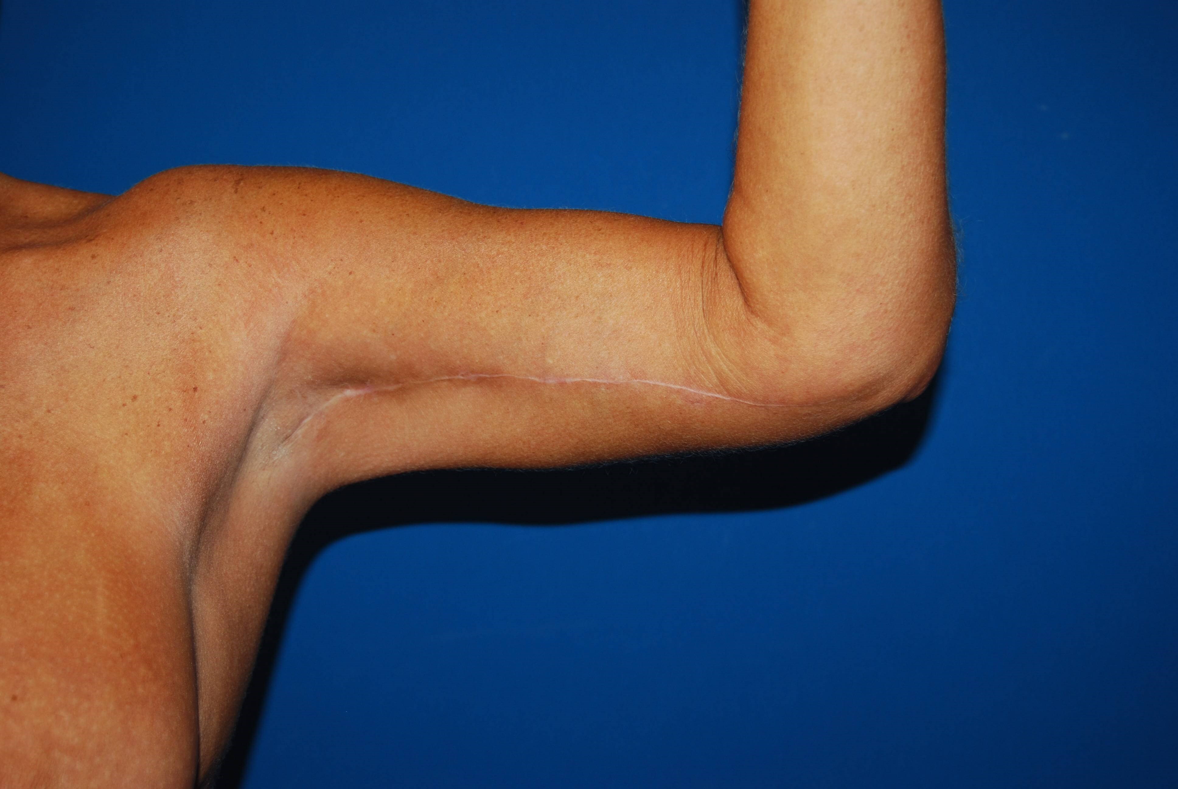 Left Arm Inner After Arm Lift