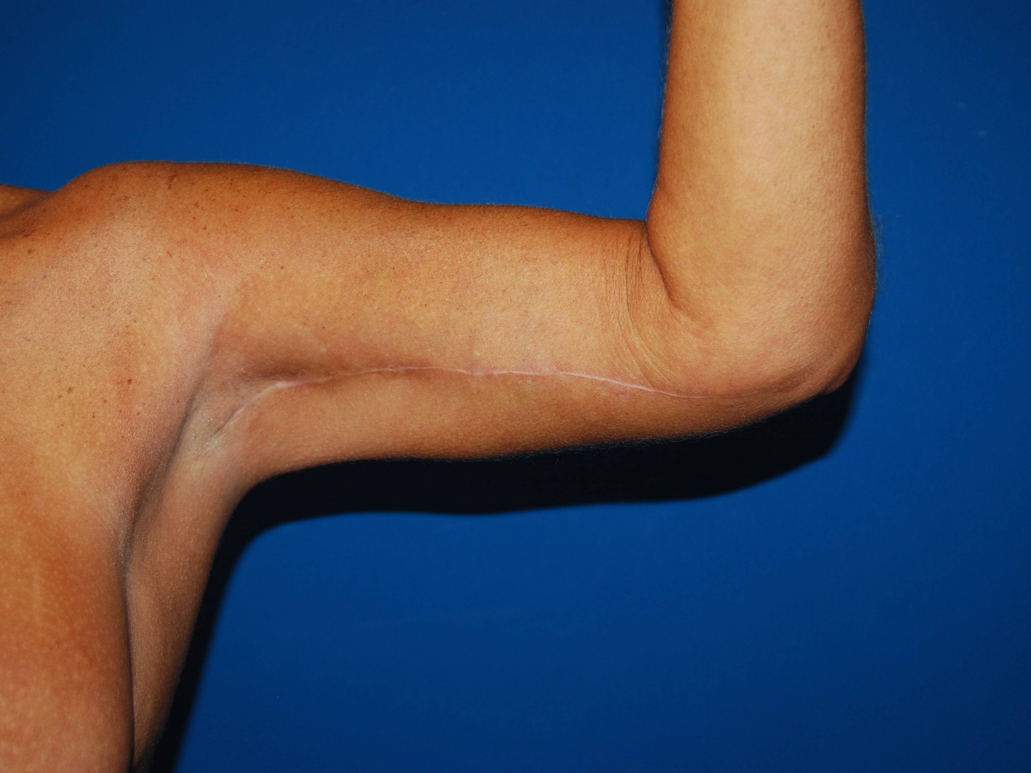 Left Arm Inner After Arm Lift