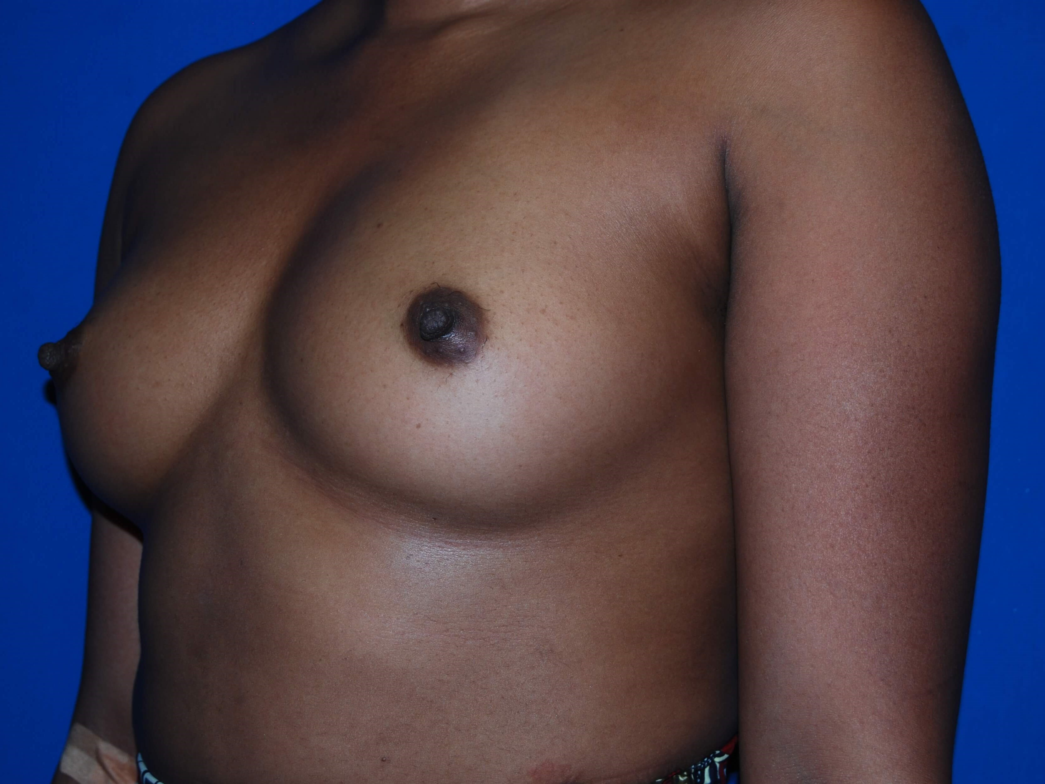 Oblique - Left Before