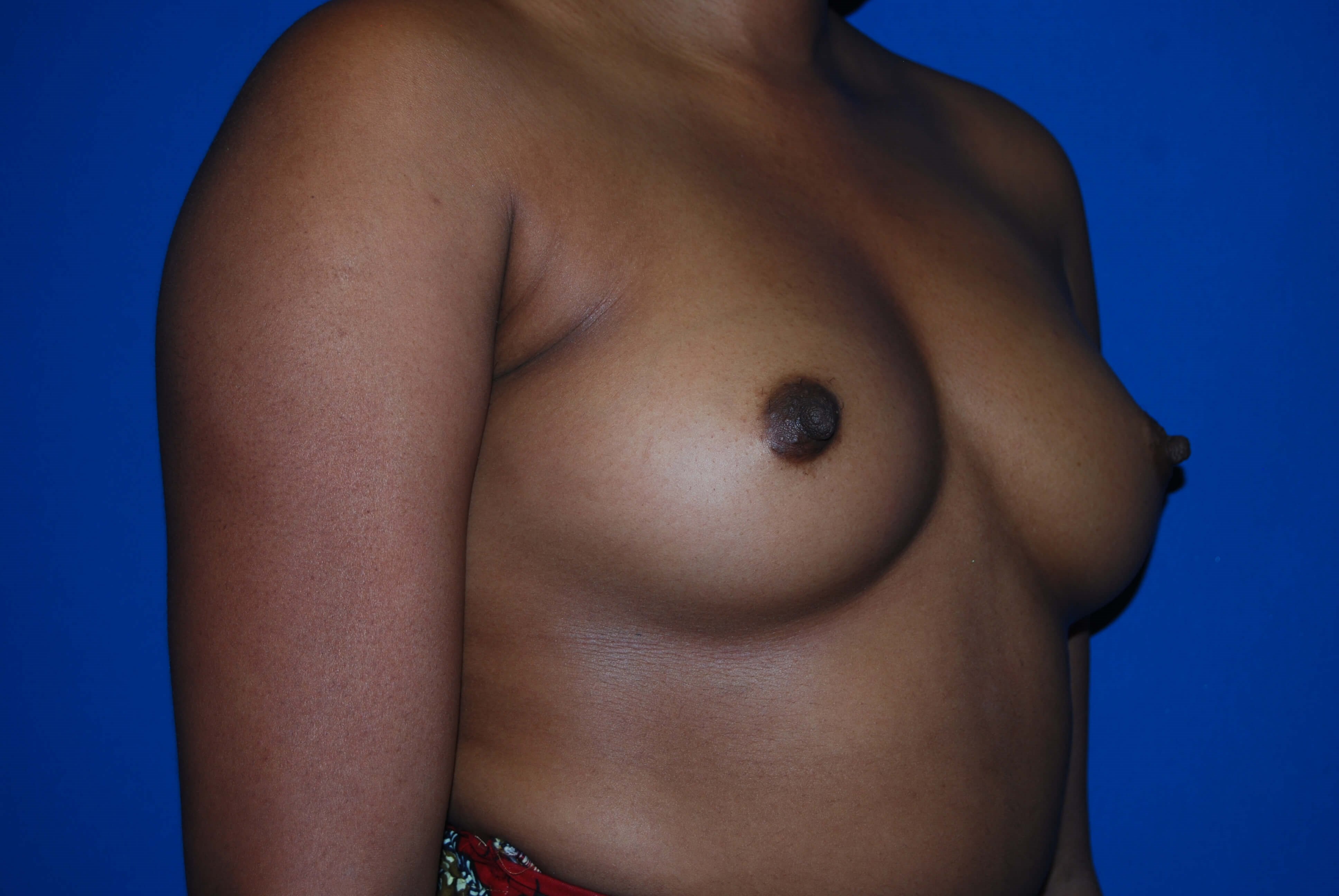 Oblique - Right Before