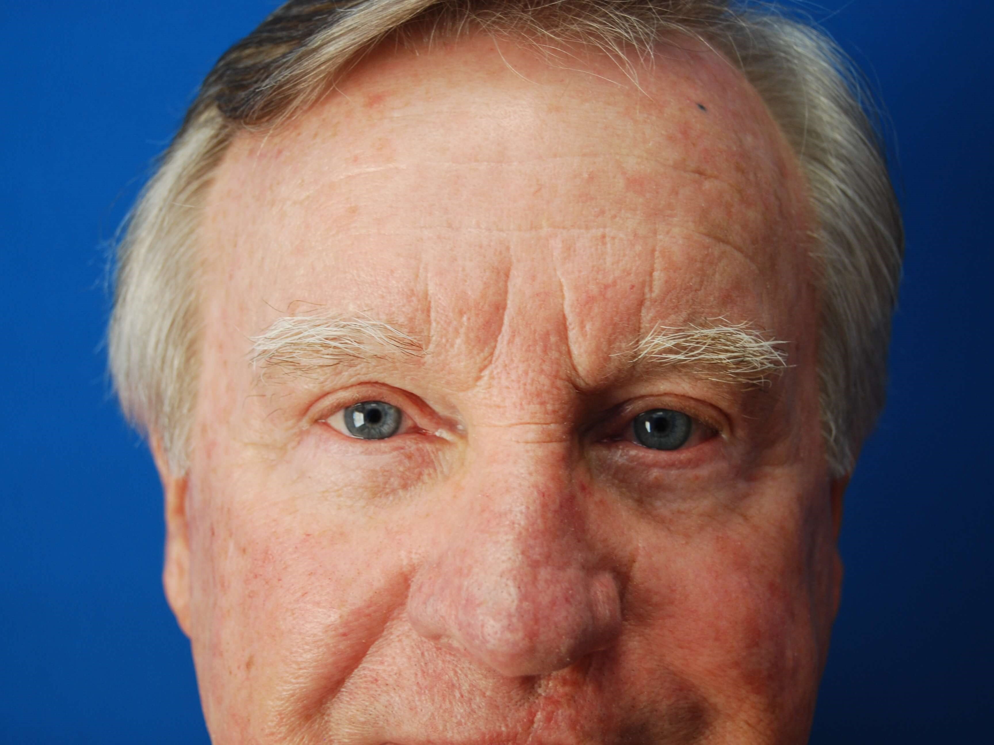 Upper & Lower Eyelids - Front After