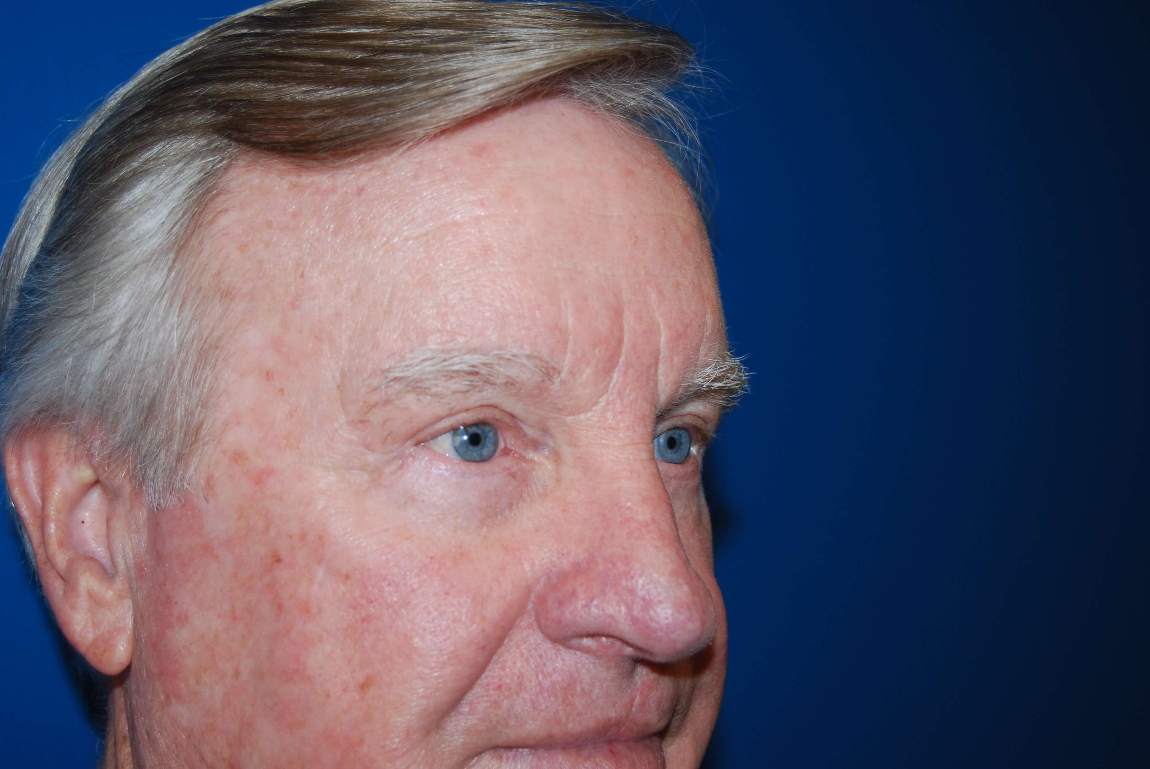 Upper & Lower Eyelids - Right After