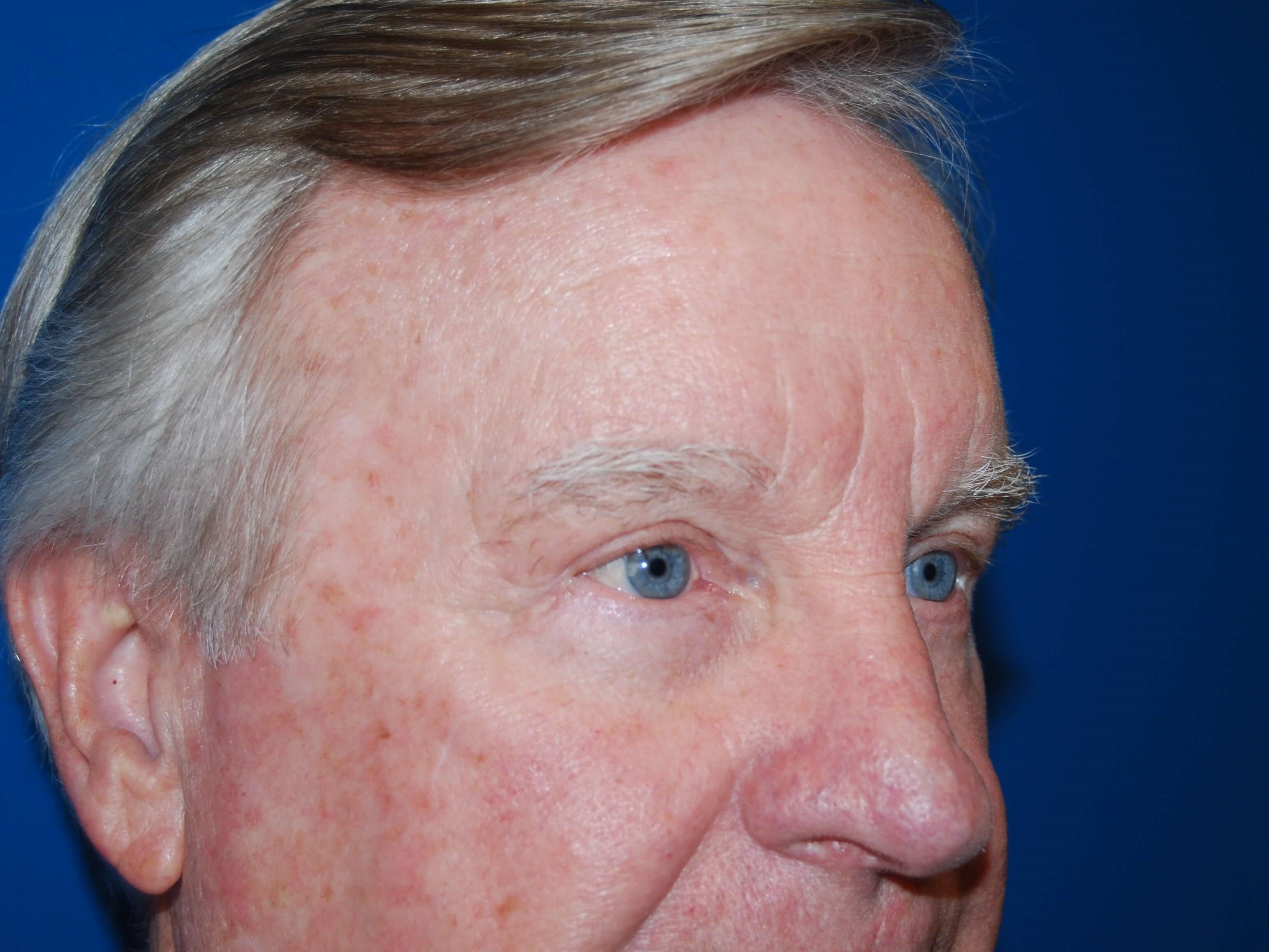 Upper & Lower Eyelids - Right After