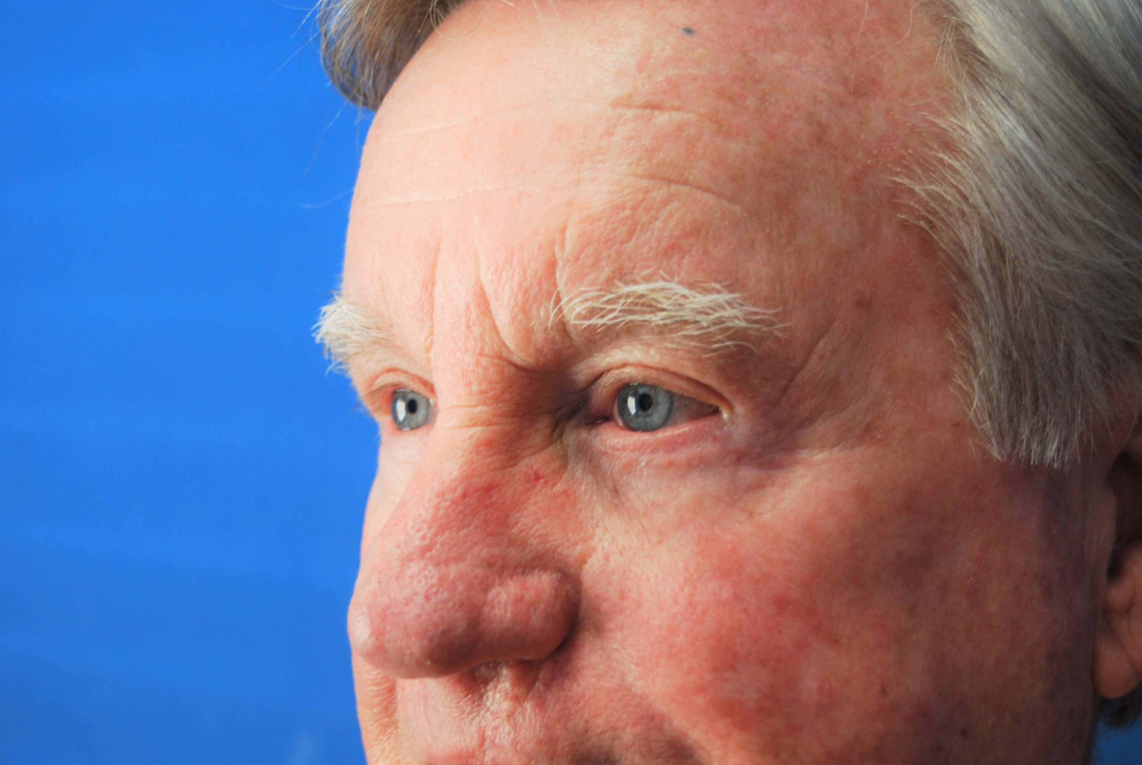 Upper & Lower Eyelids - Left After