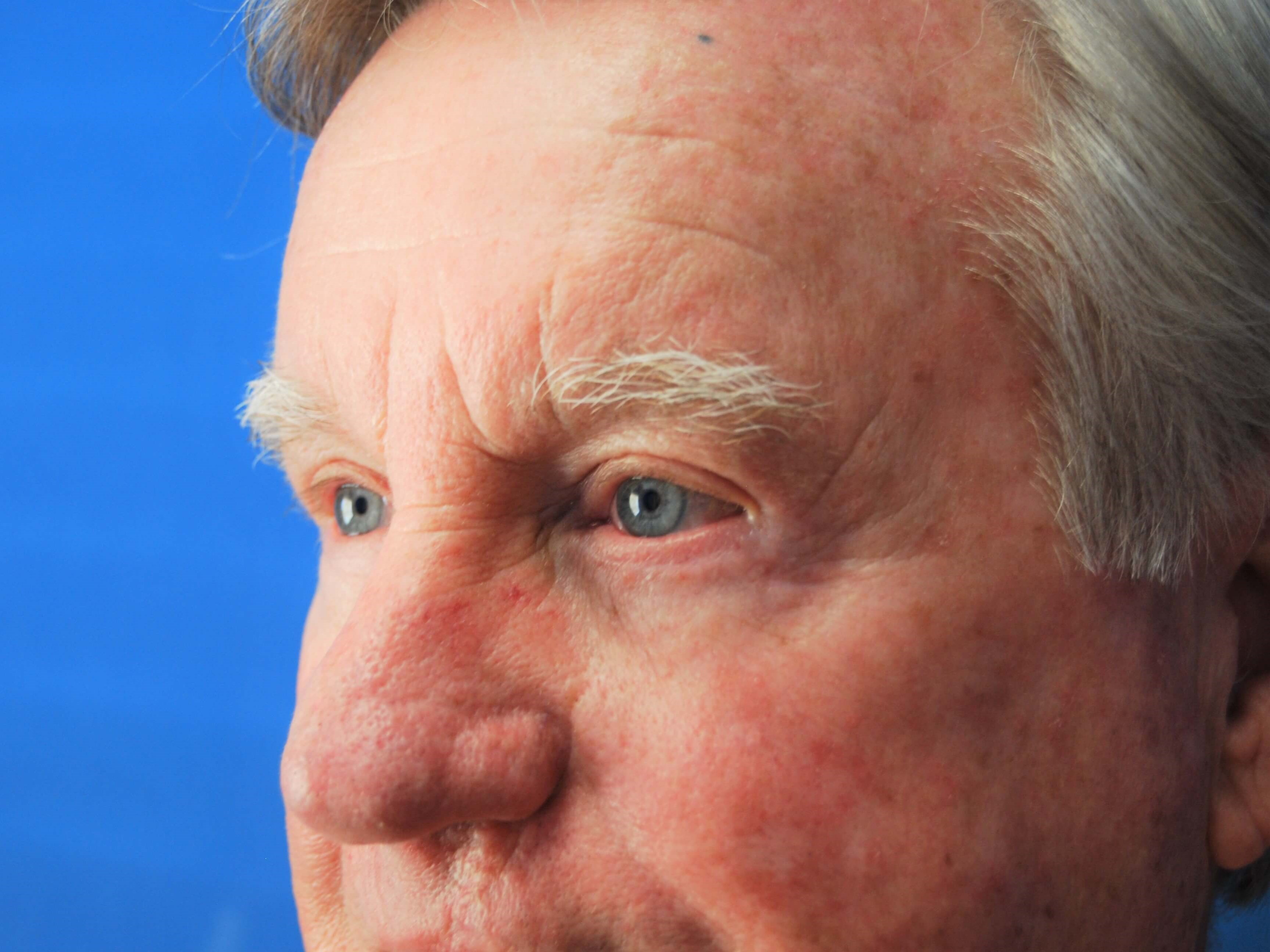 Upper & Lower Eyelids - Left After