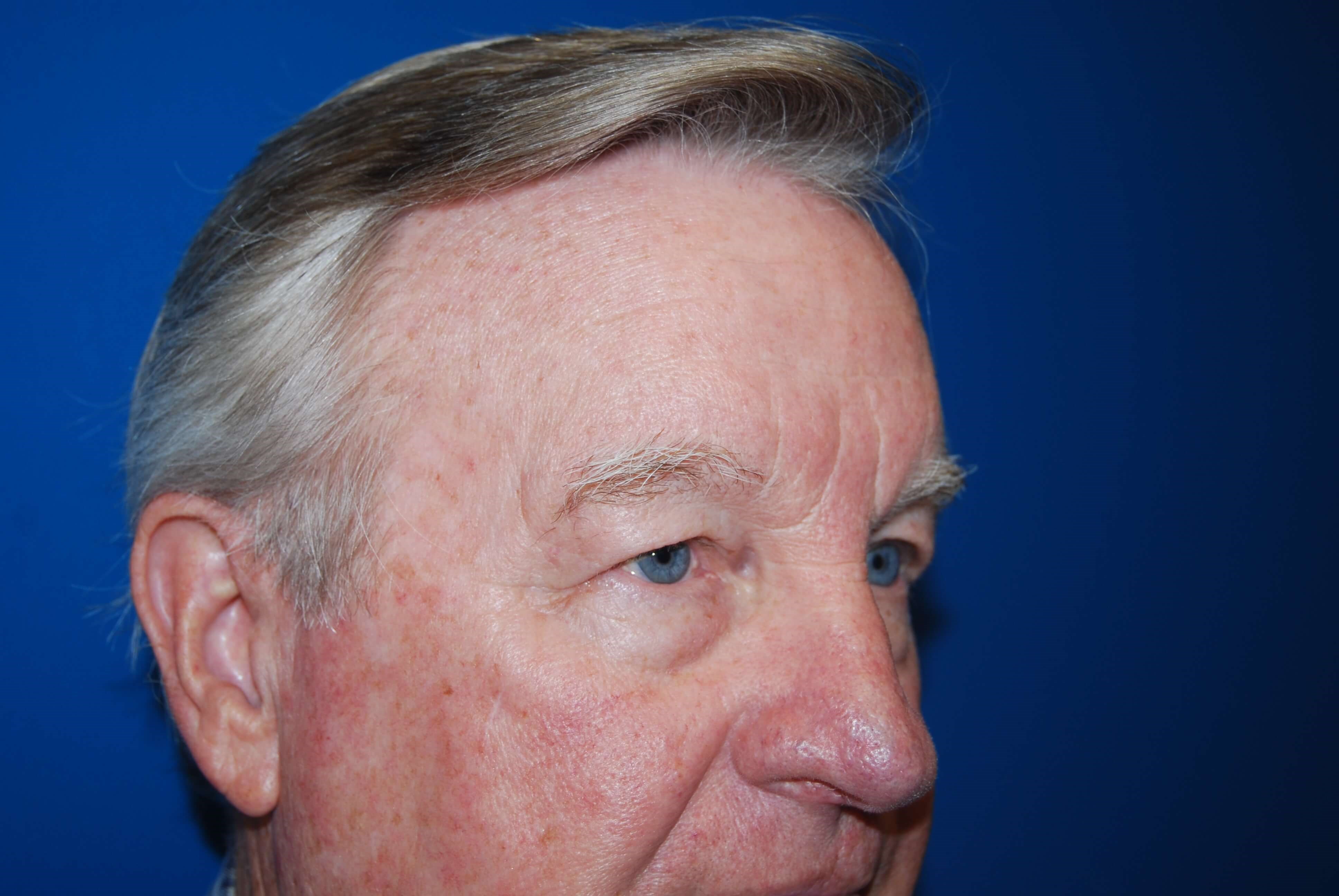 Upper & Lower Eyelids - Right Before