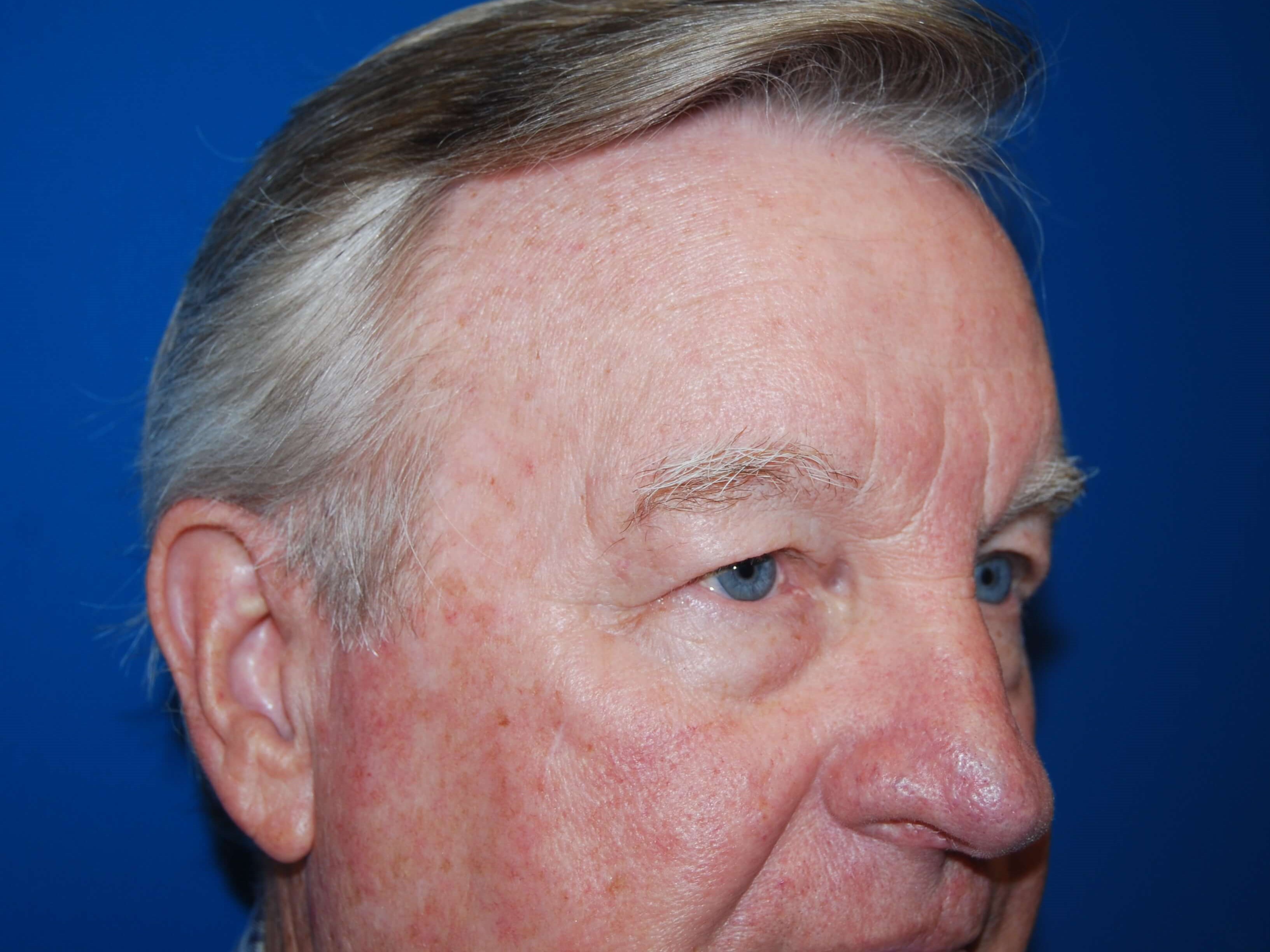 Upper & Lower Eyelids - Right Before