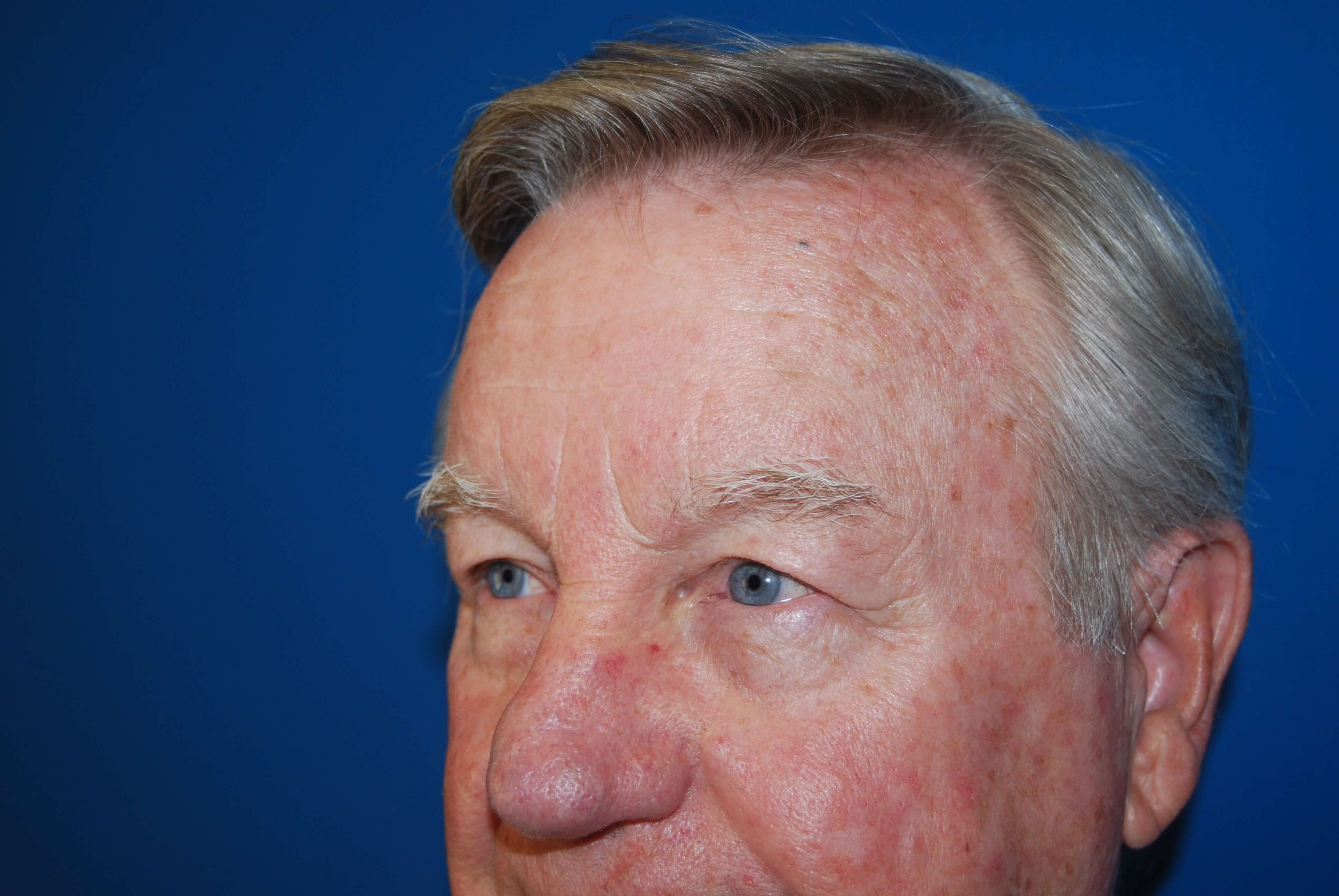 Upper & Lower Eyelids - Left Before