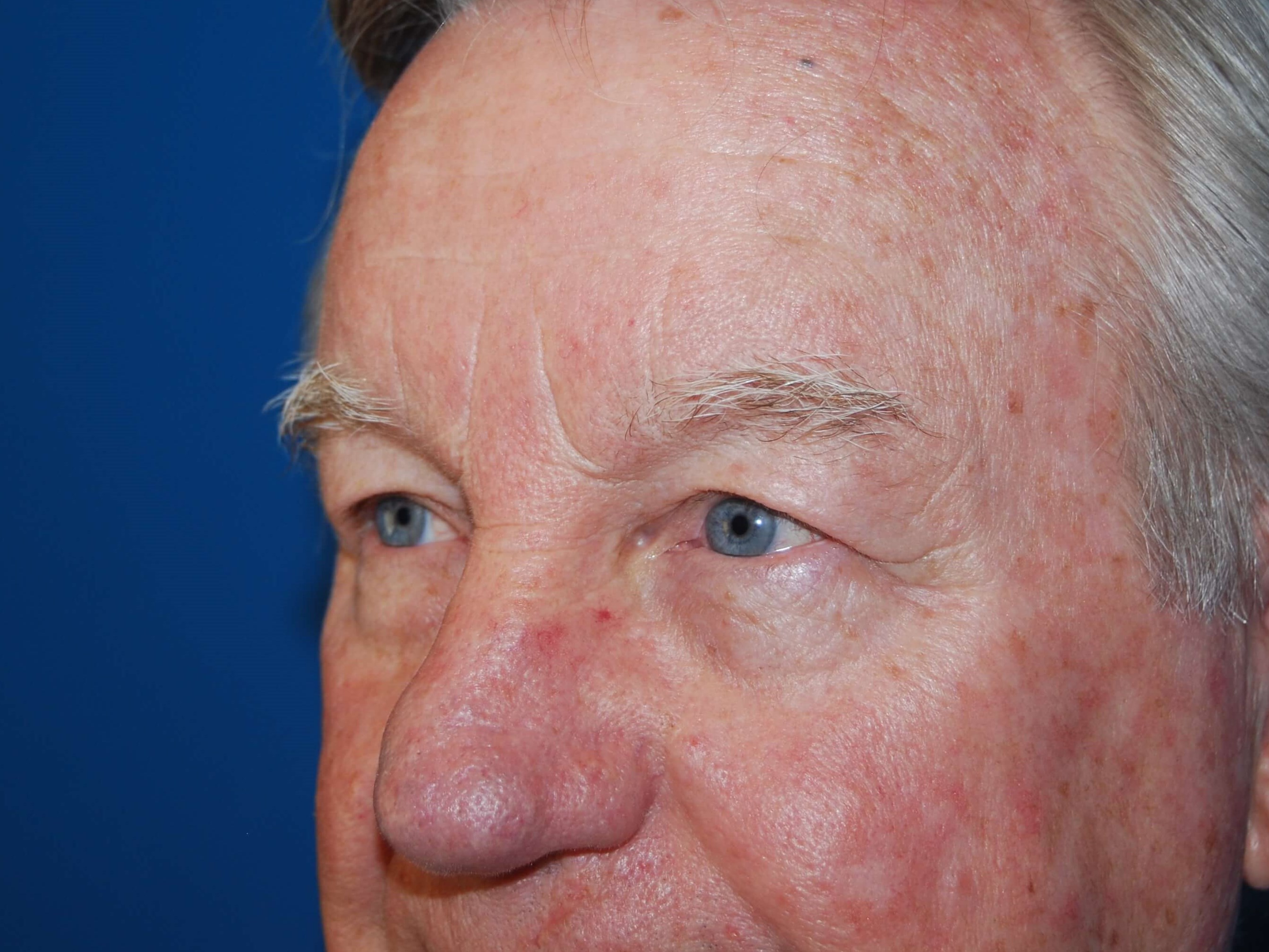 Upper & Lower Eyelids - Left Before