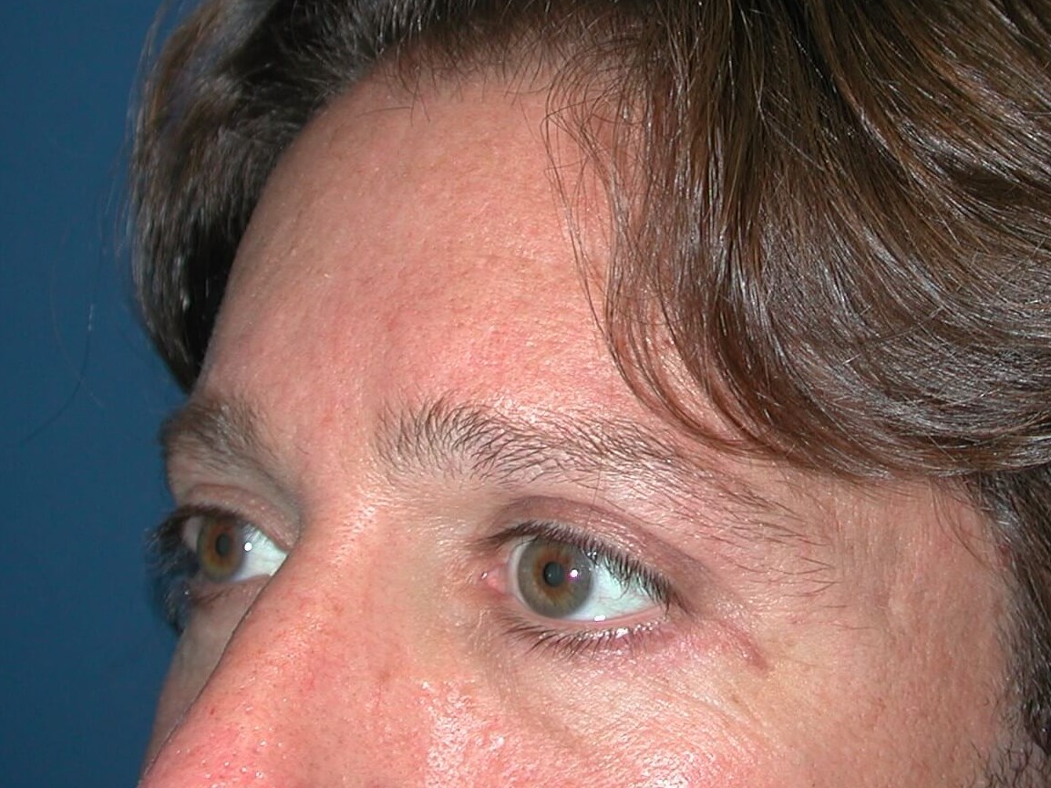 Left View After