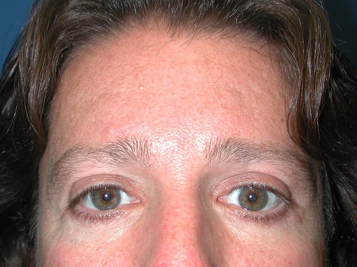 Front View After
