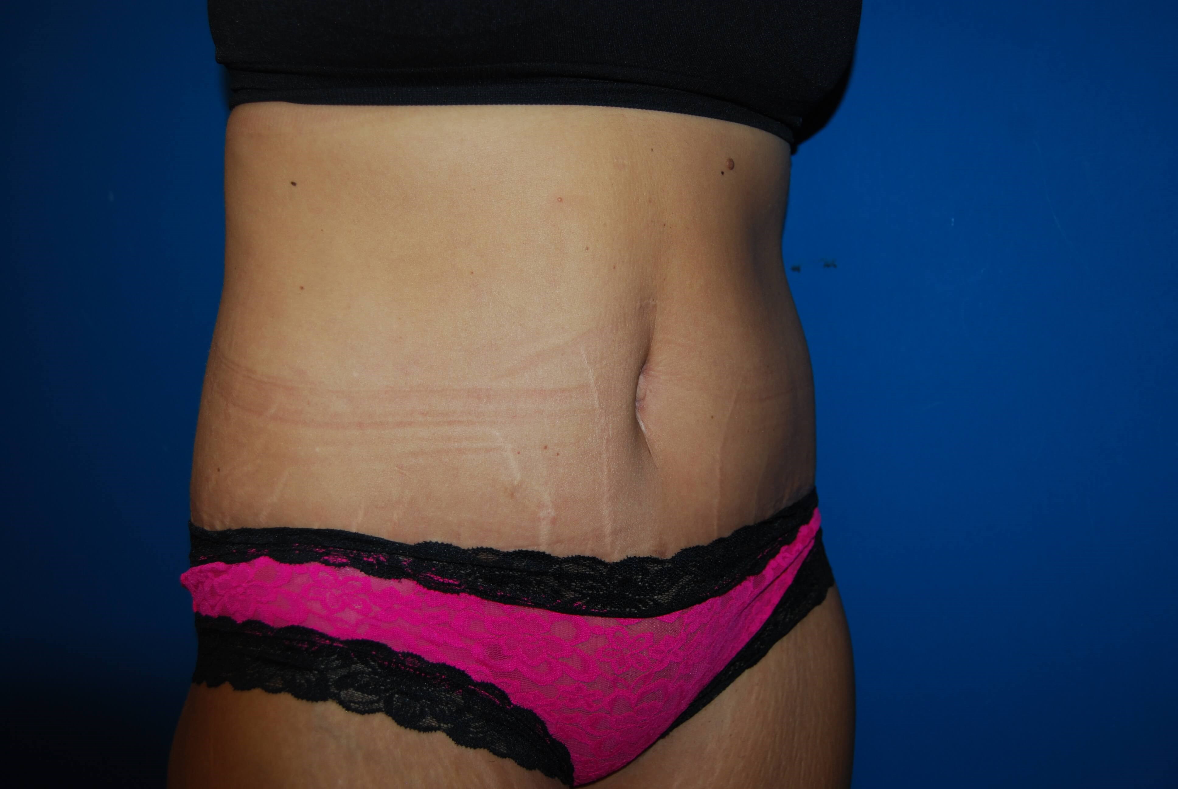 Oblique - Right 1 Month After