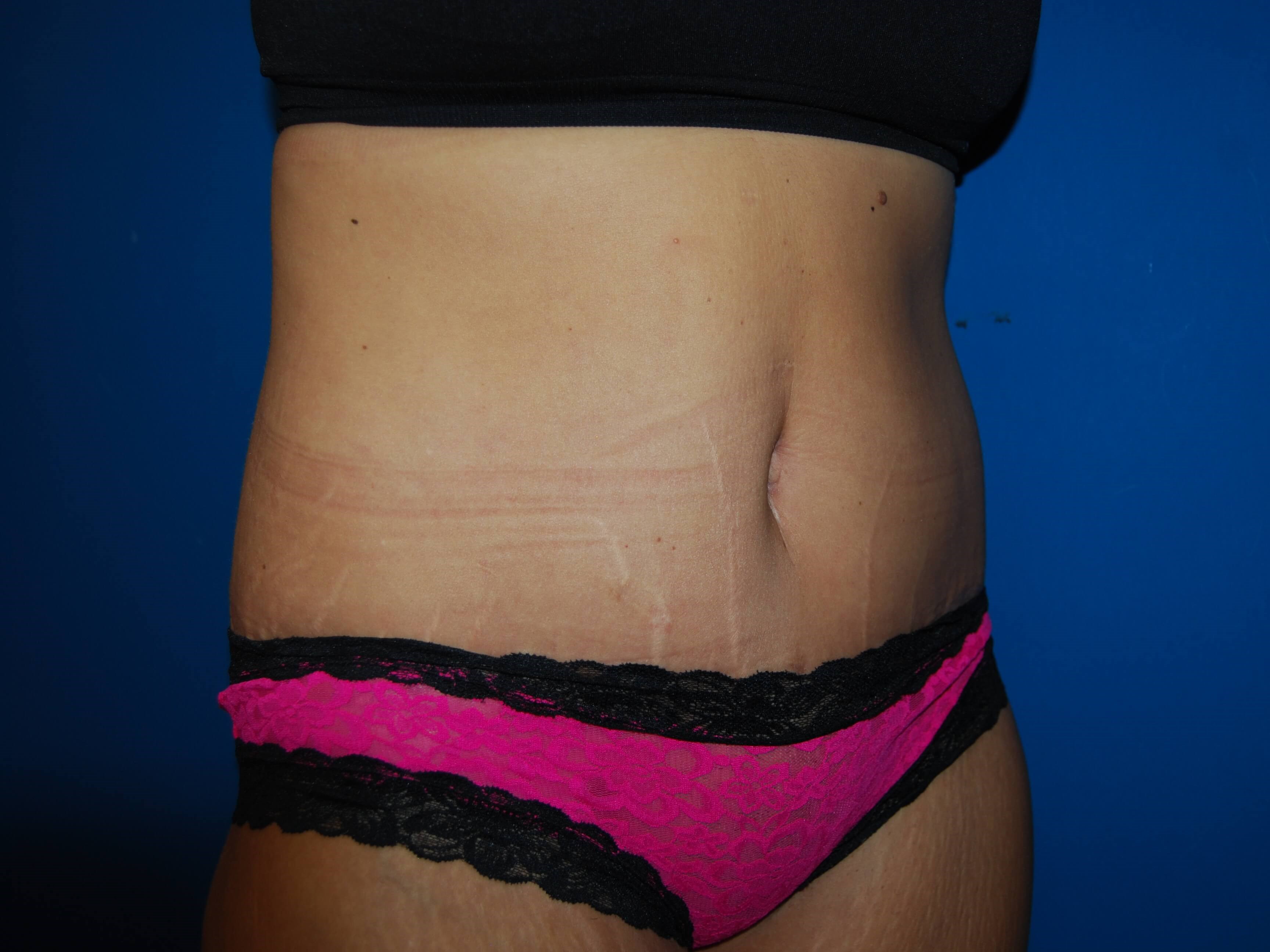 Oblique - Right 1 Month After